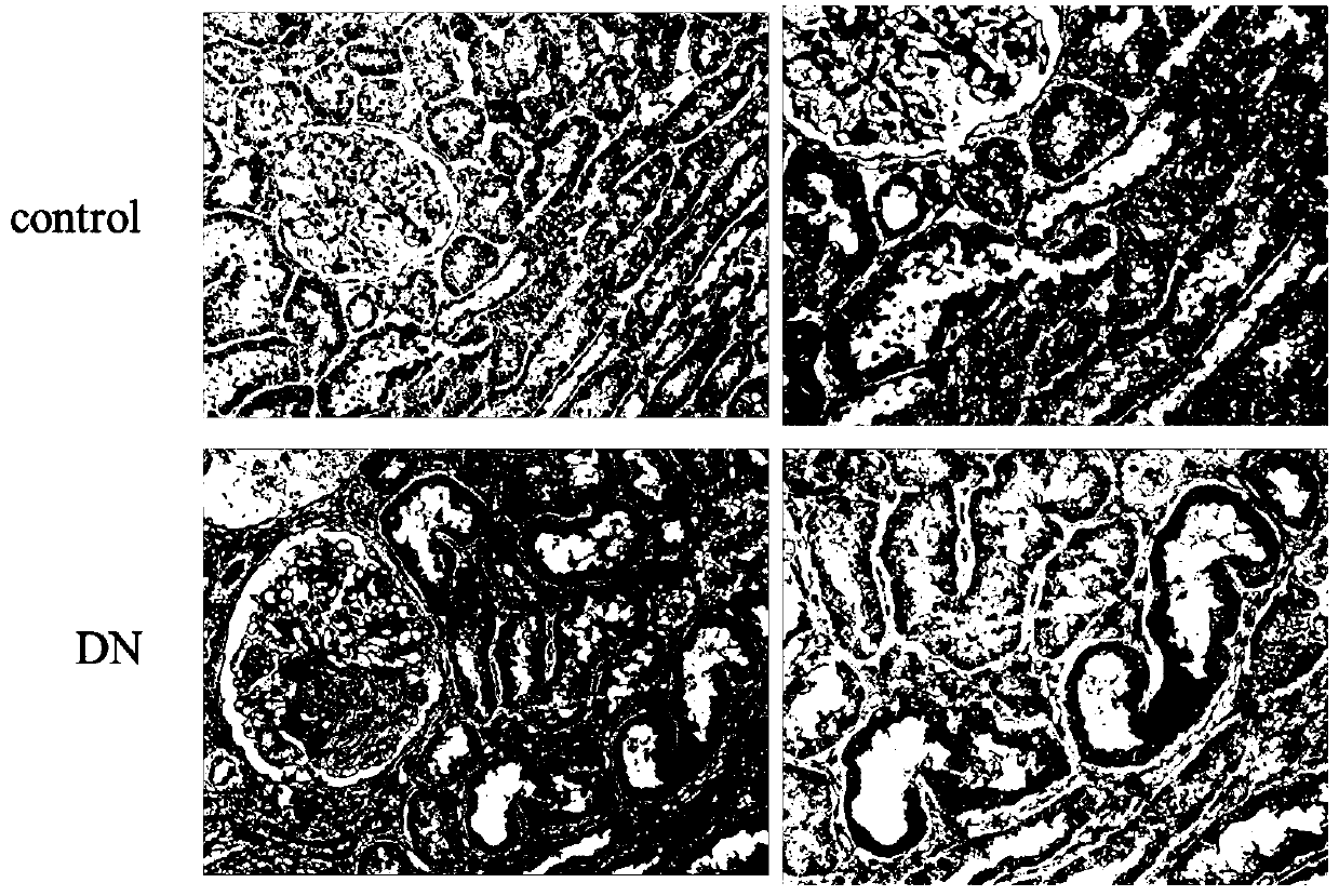 Application of secretory leukocyte protease inhibitor (SLPI) as prognostic marker of diabetic nephropathy (DN)