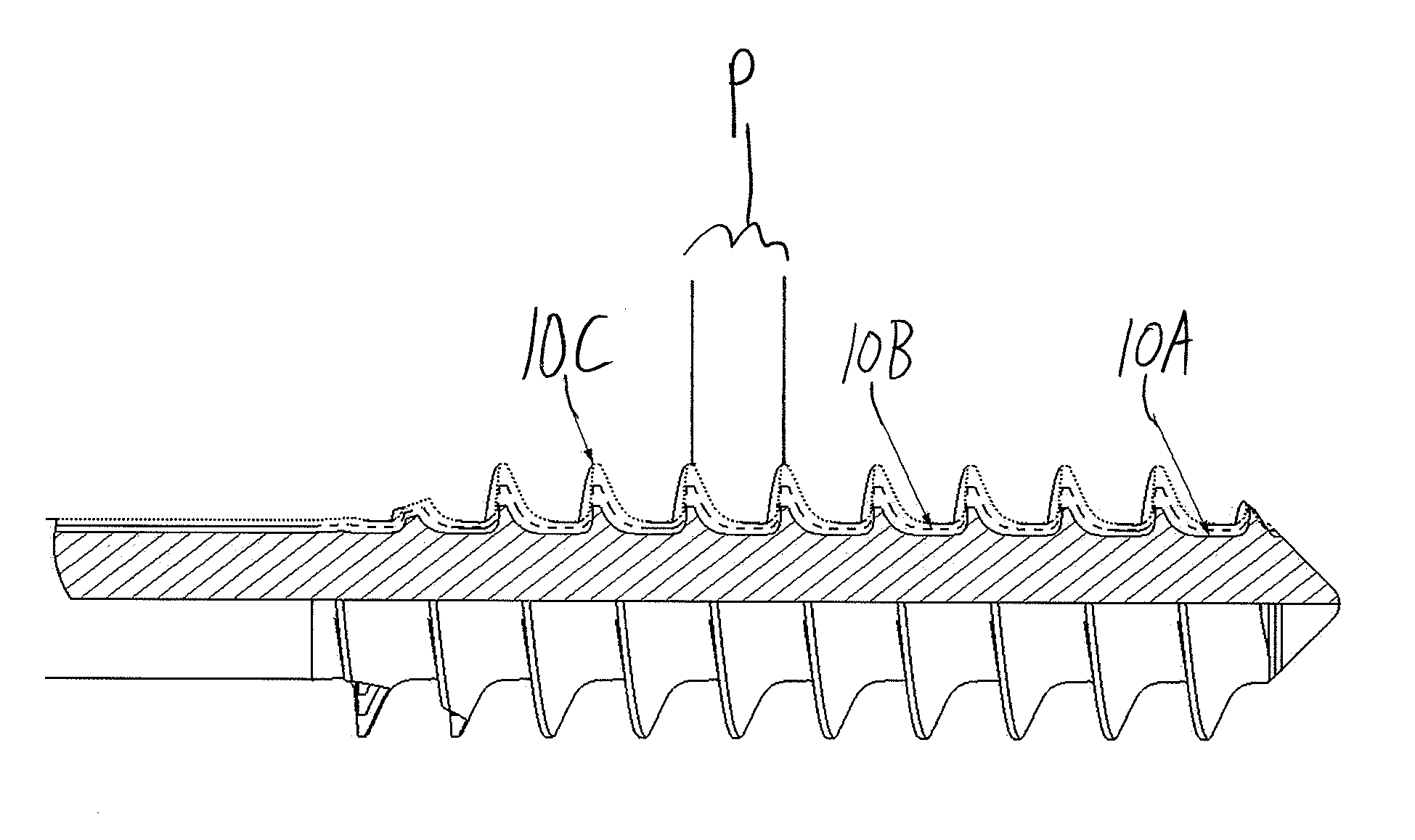 Bone screw system