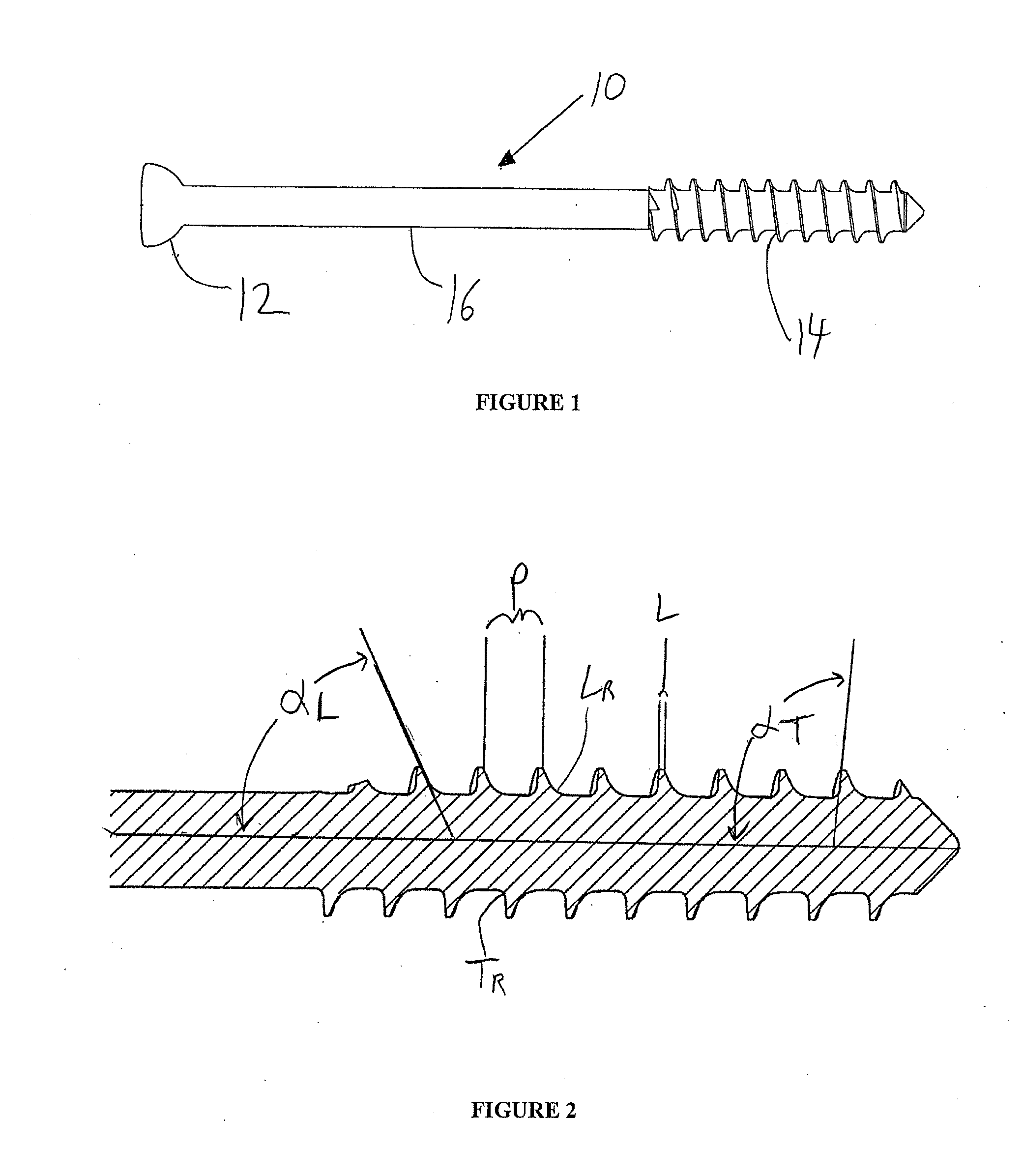 Bone screw system