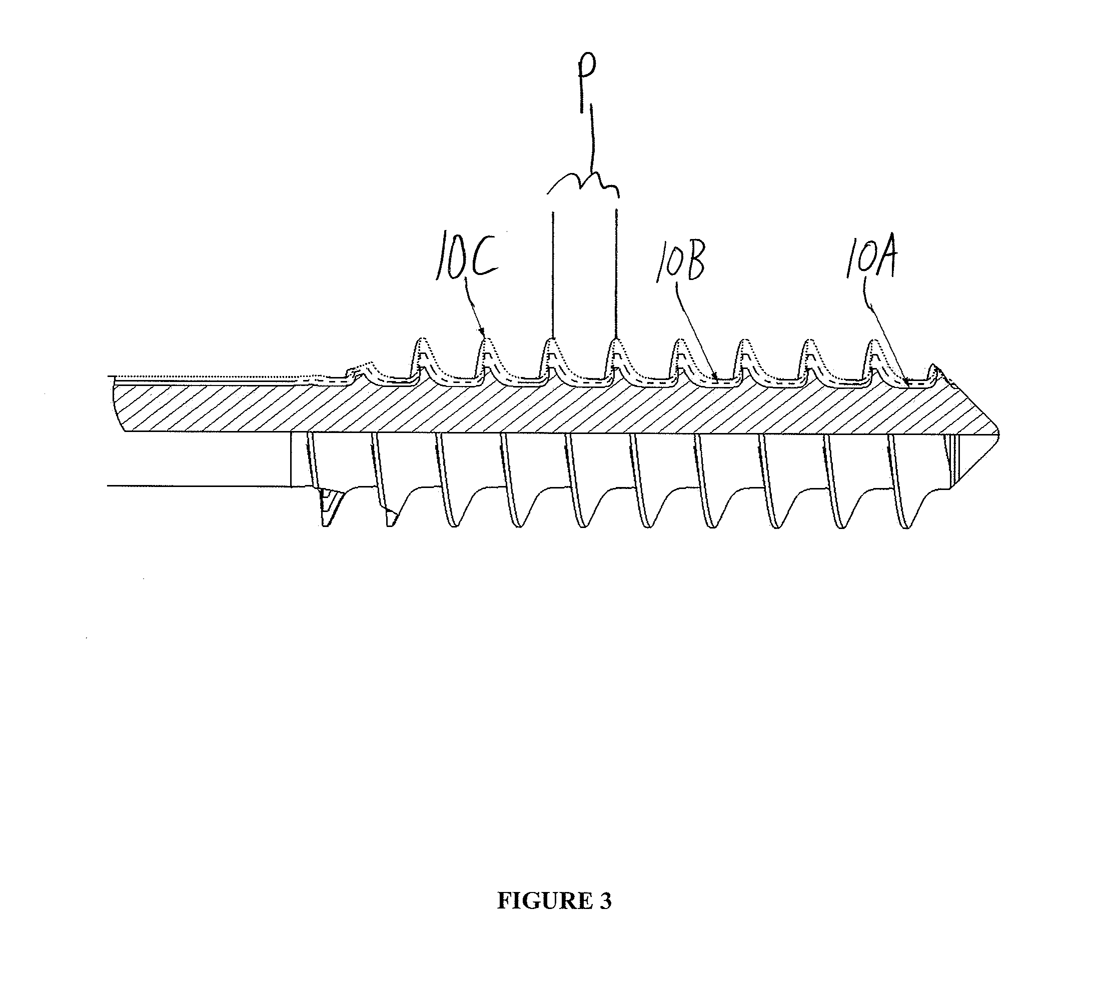 Bone screw system