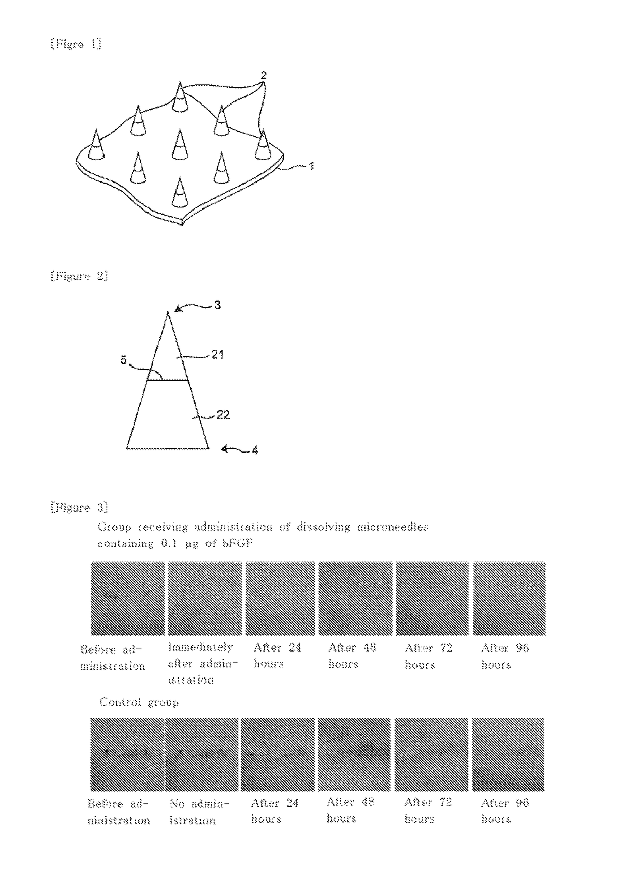 Microneedle assembly formulation for skin treatment