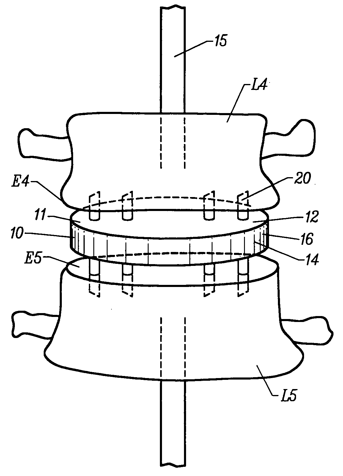 Method and apparatus for intervertebral implant anchorage