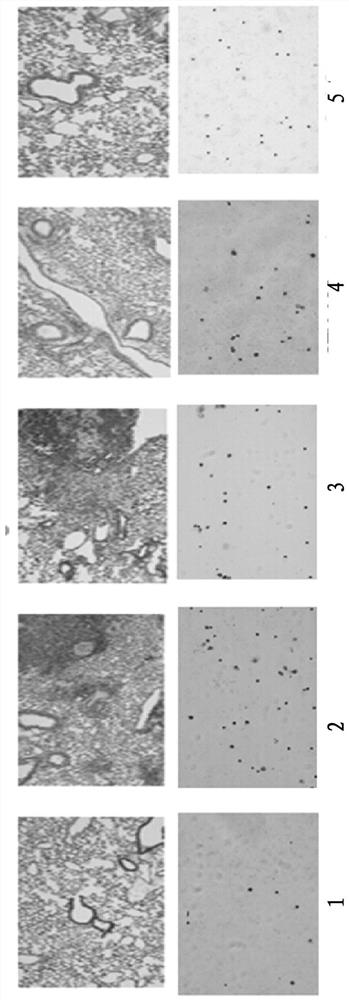 Application of thymosin beta4 in preparation of medicine for treating pulmonary fibrosis complicated with lung cancer disease