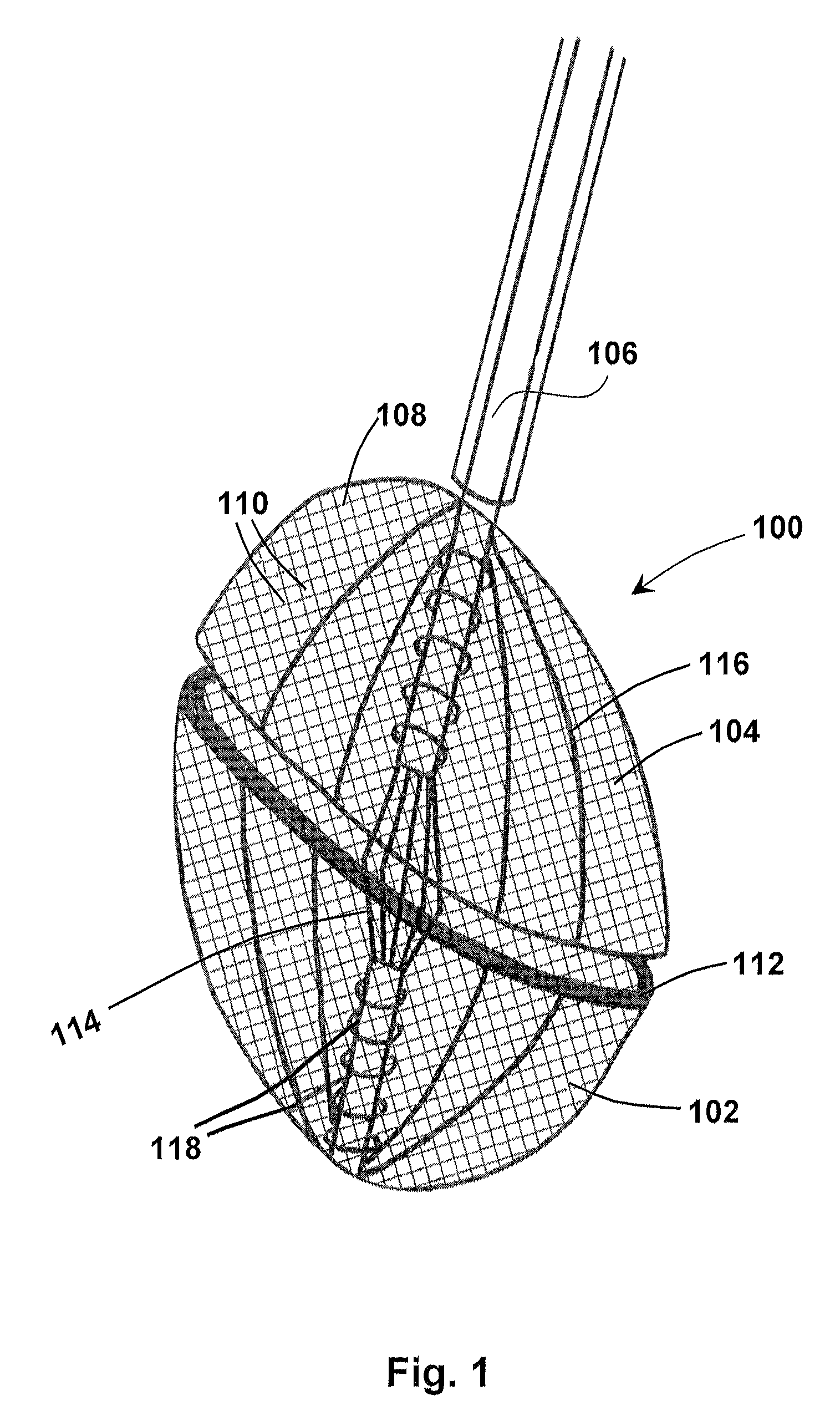 Methods for removing a valve from a vessel