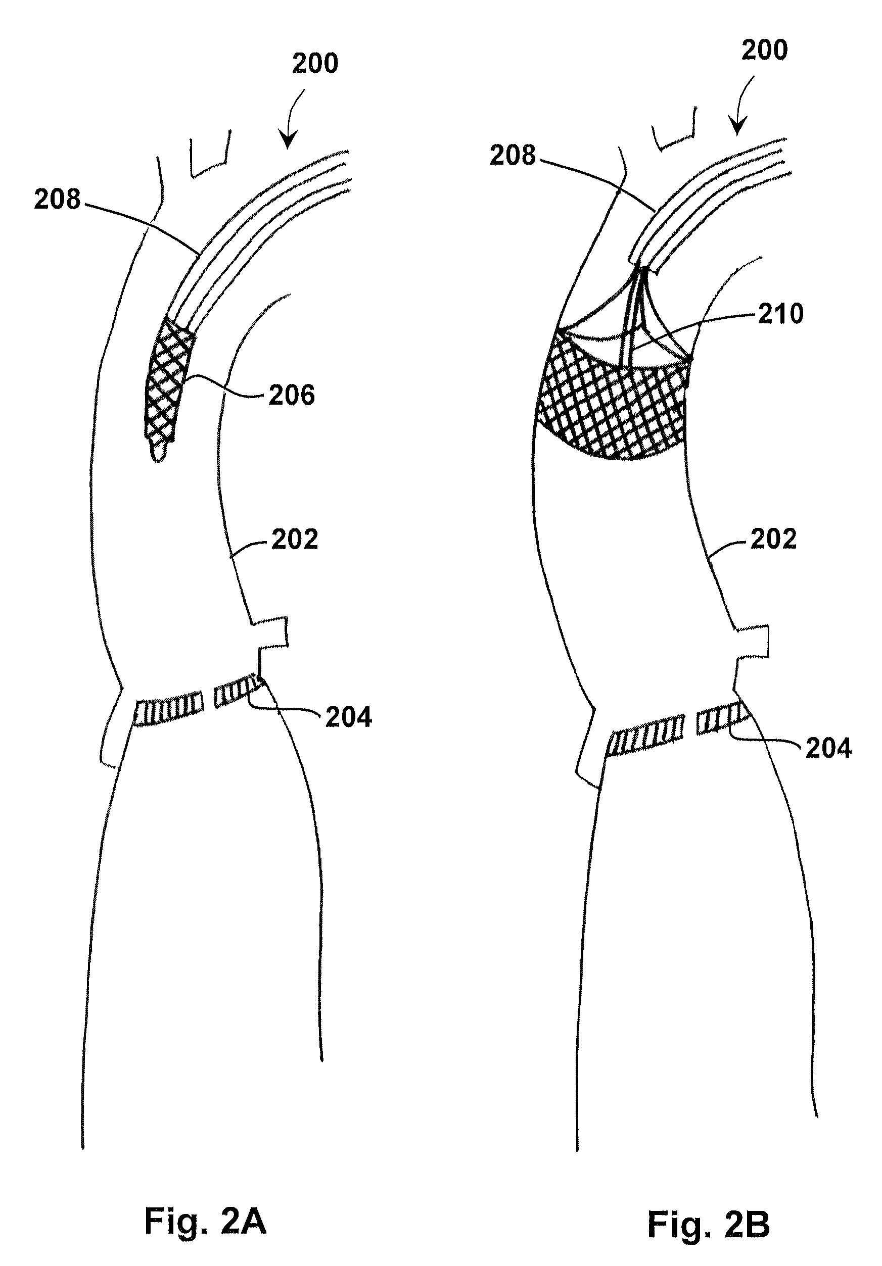 Methods for removing a valve from a vessel