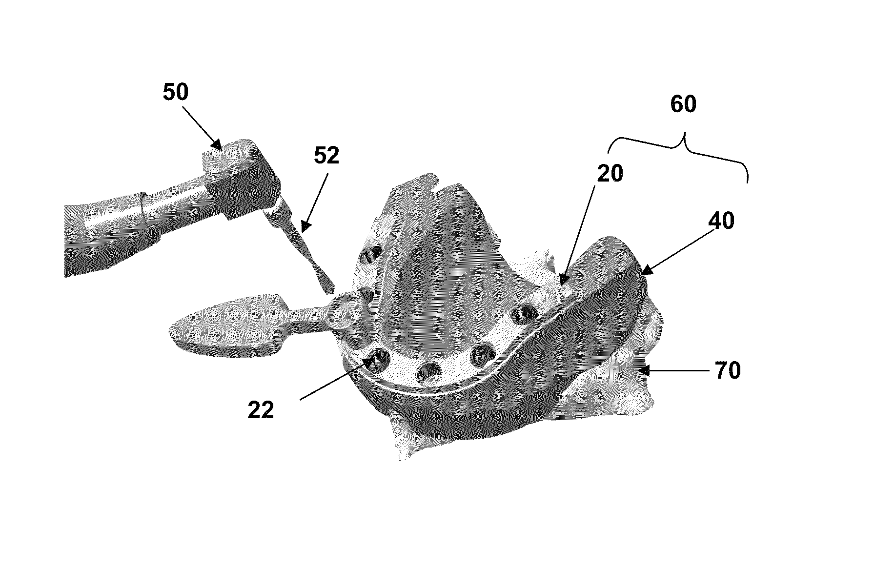 Dental prosthesis system