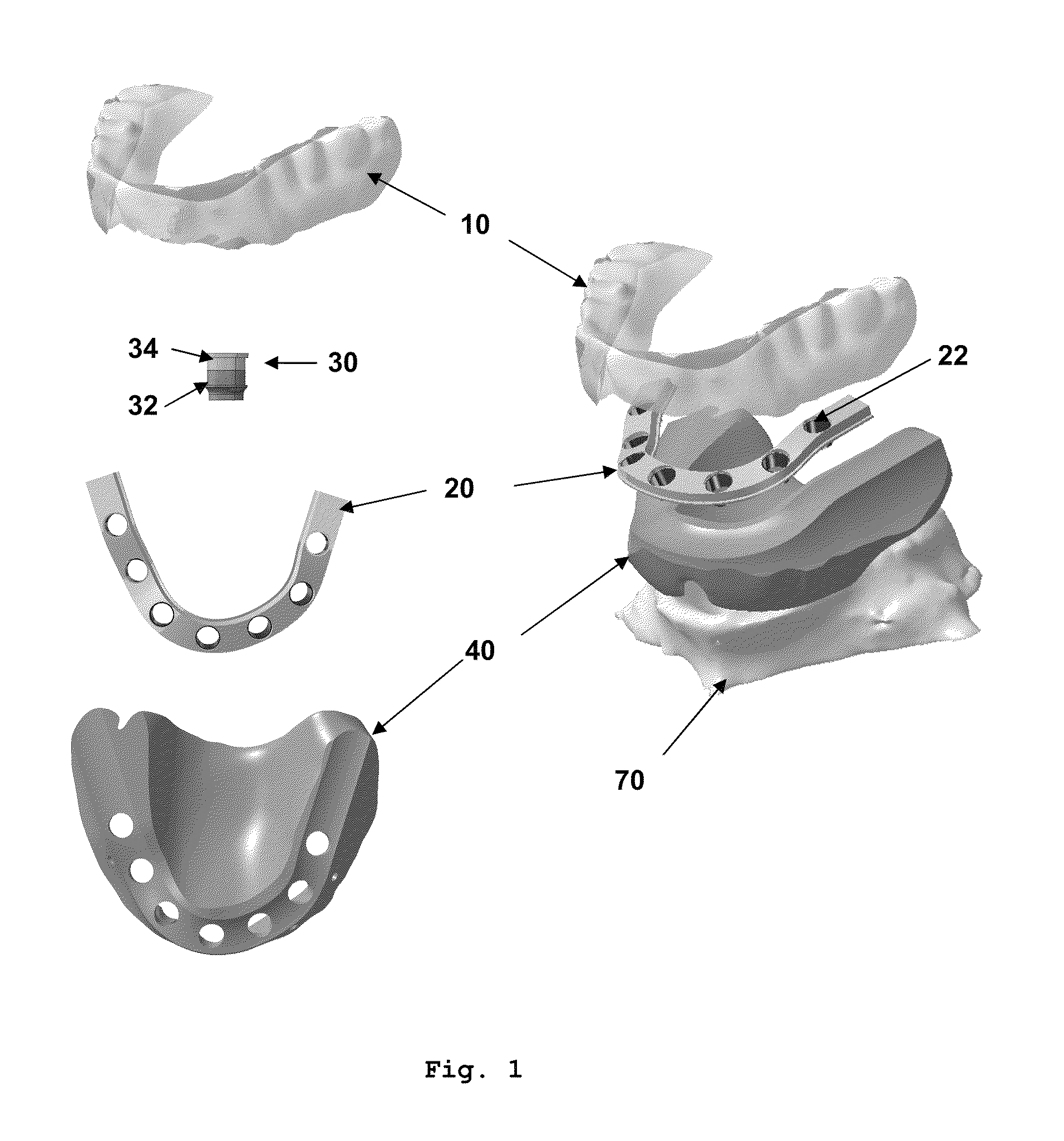 Dental prosthesis system