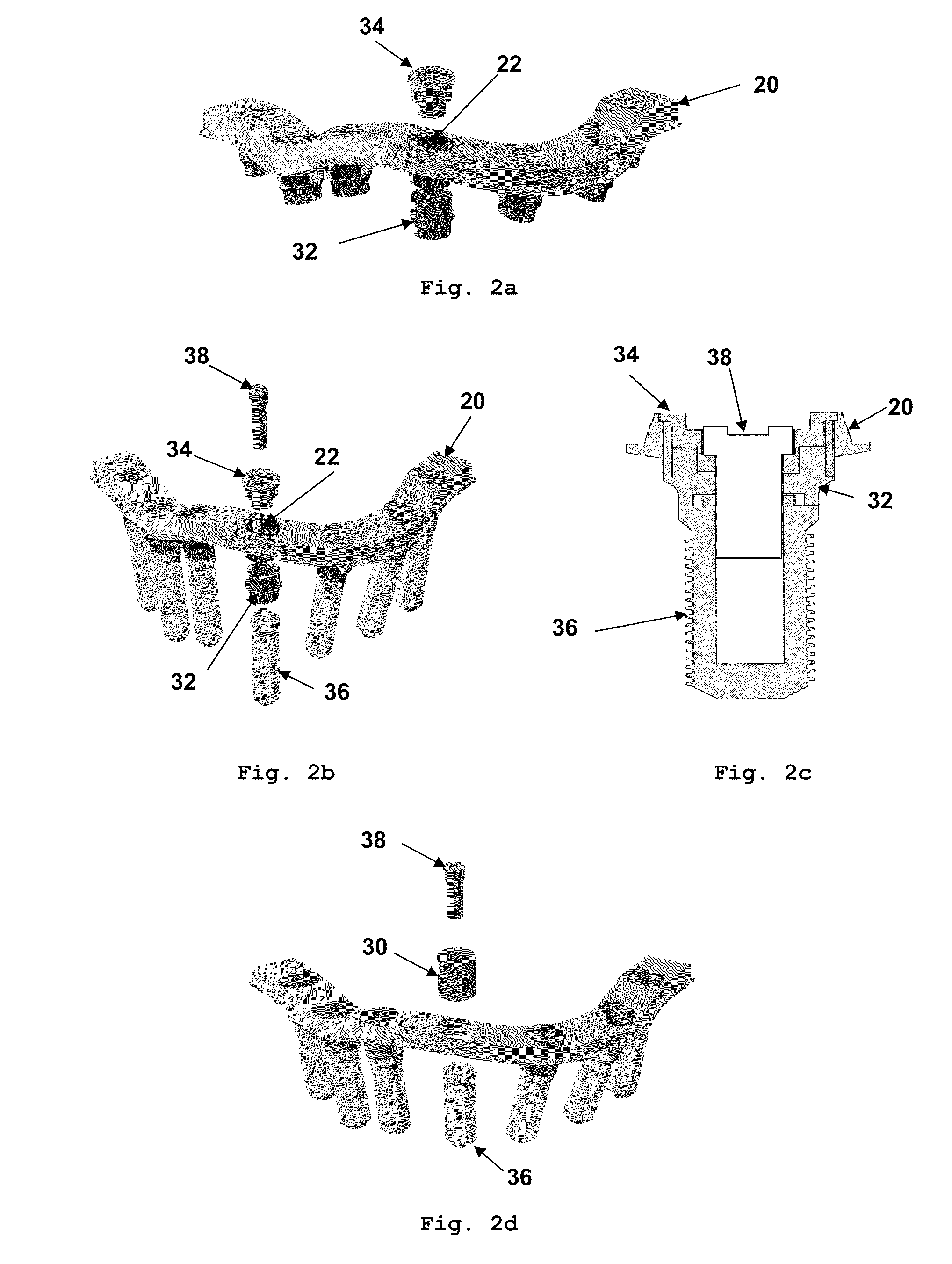 Dental prosthesis system