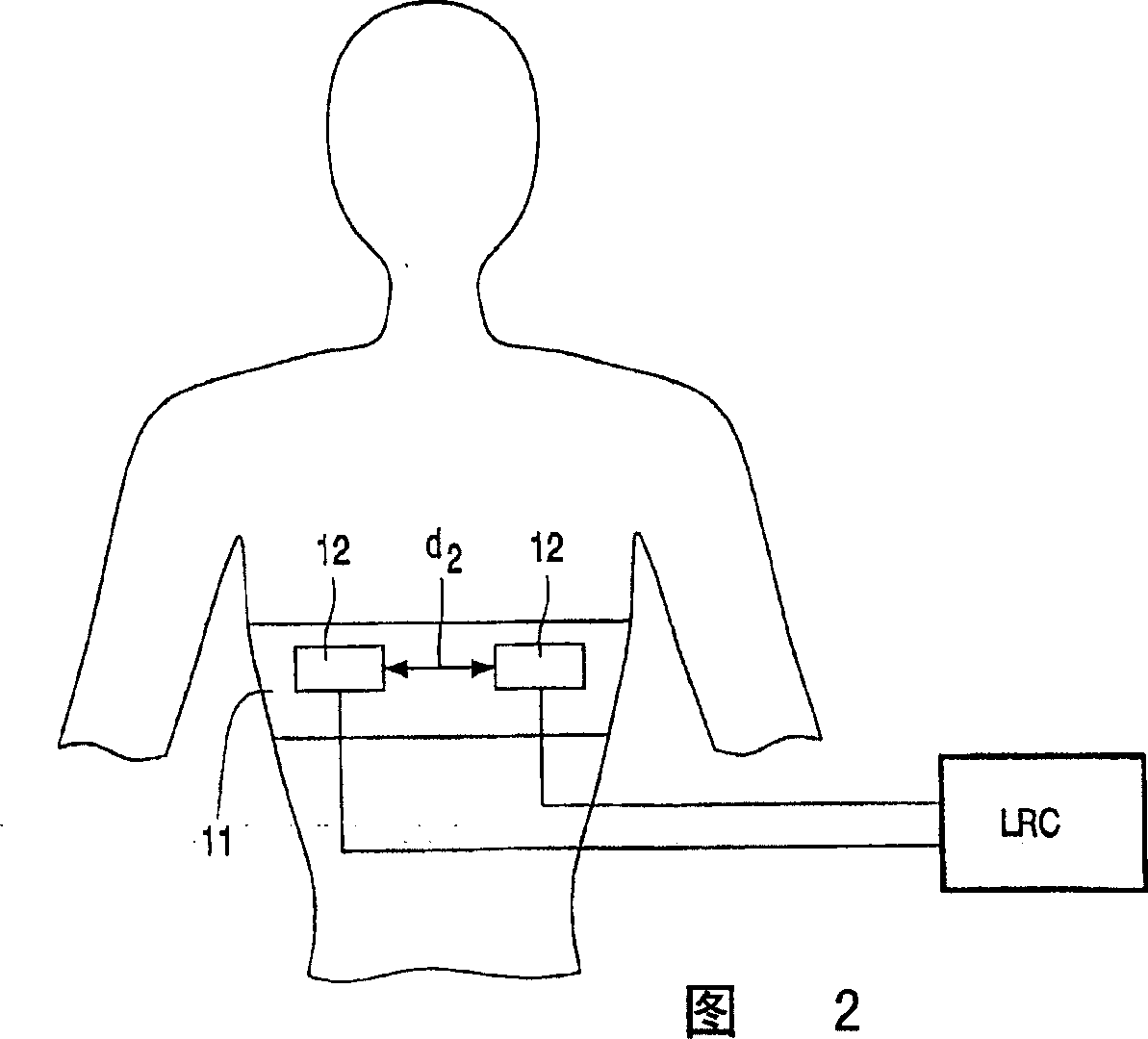 Electrode arrangement