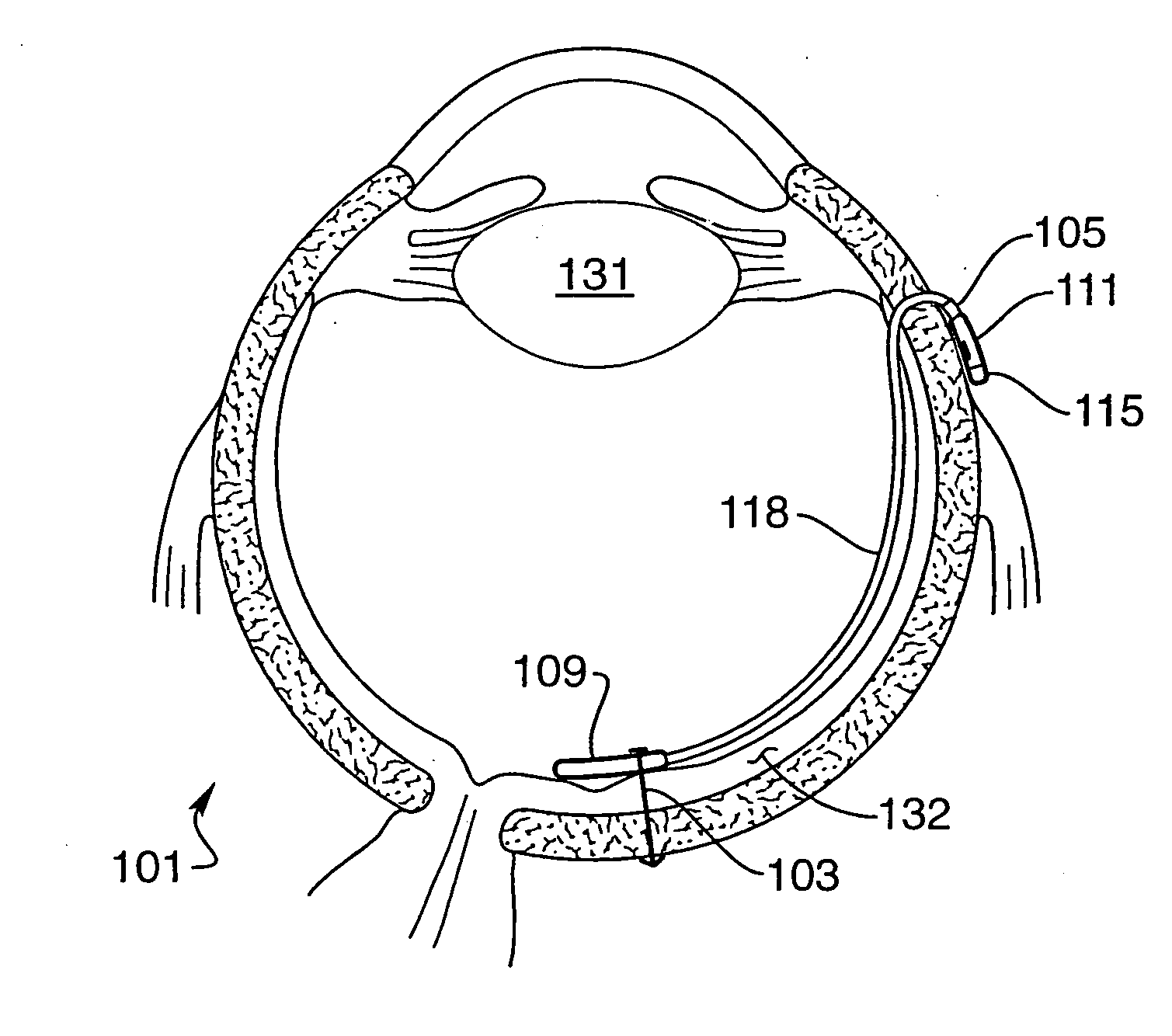 Implantable drug delivery device