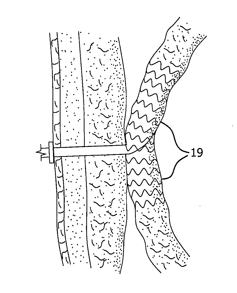 Medical Device for use with a Stoma