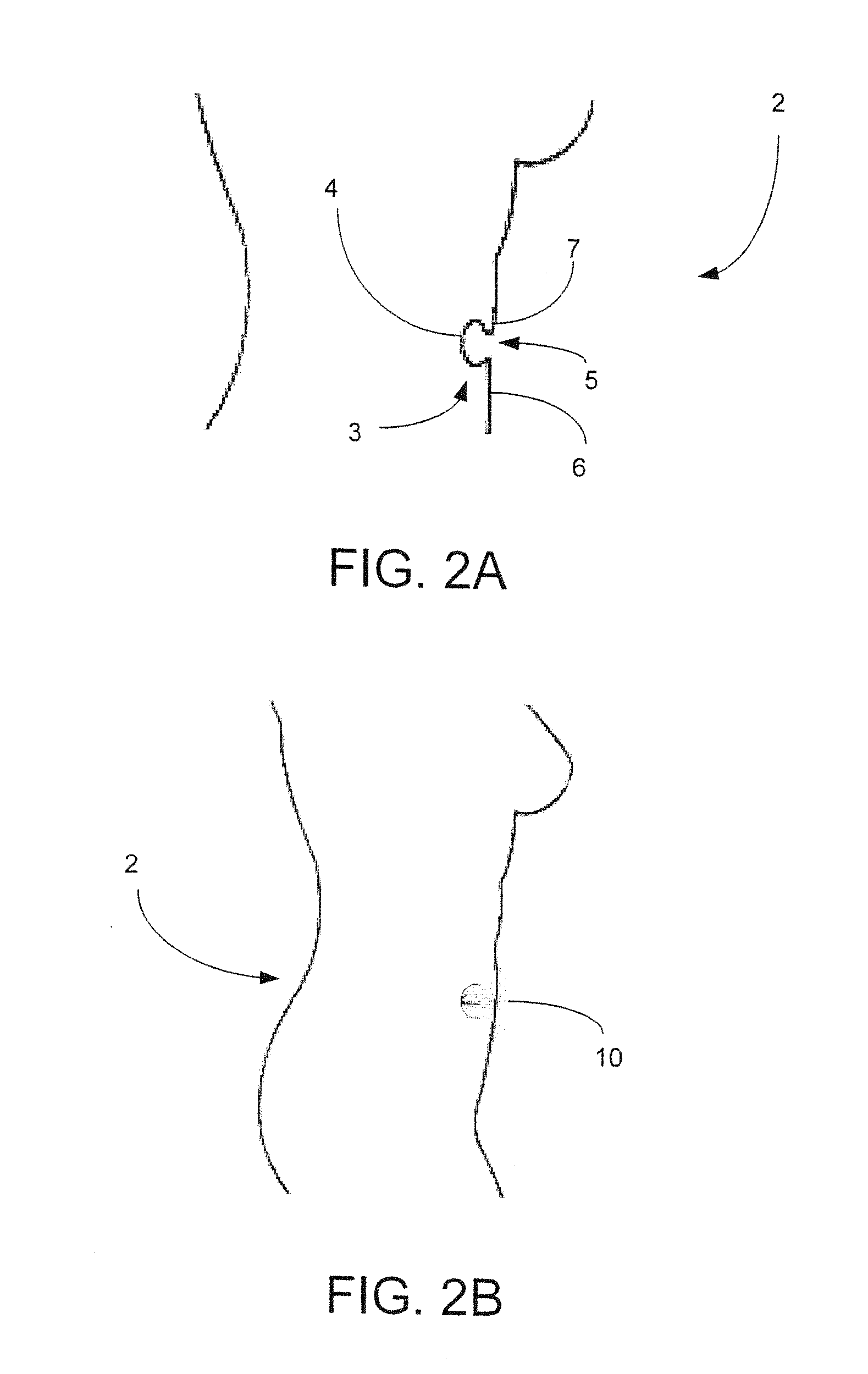 Umbilical Splint and Method of Use