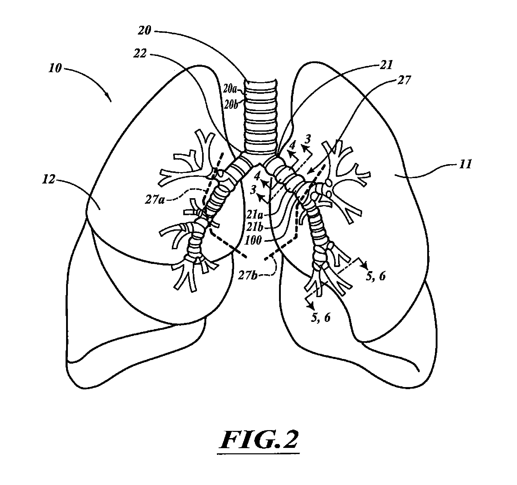 Systems, devices, and methods for treating a pulmonary disorder with an agent