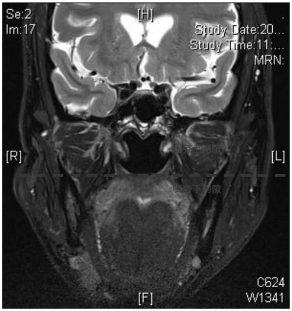 Endoscopic para-pharyngeal space tumor excision method