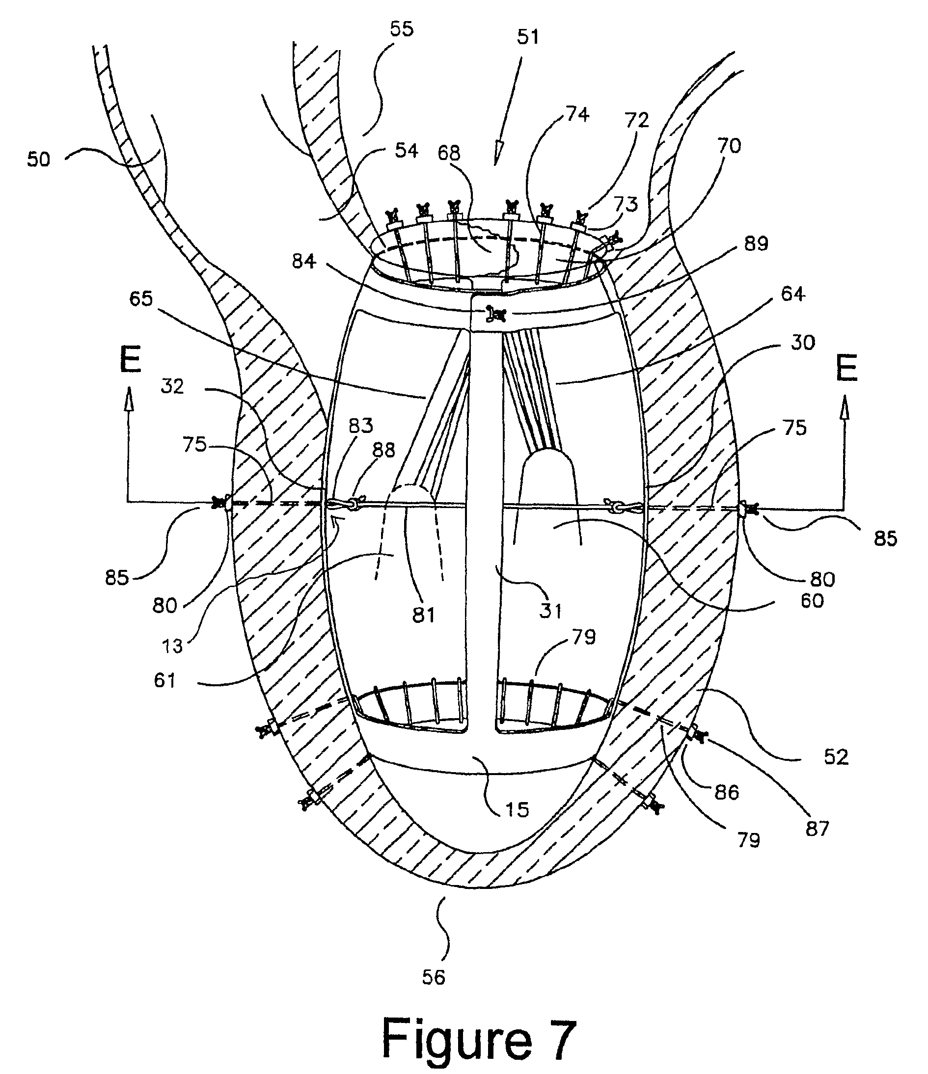 Method and apparatus for the surgical treatment of congestive heart failure