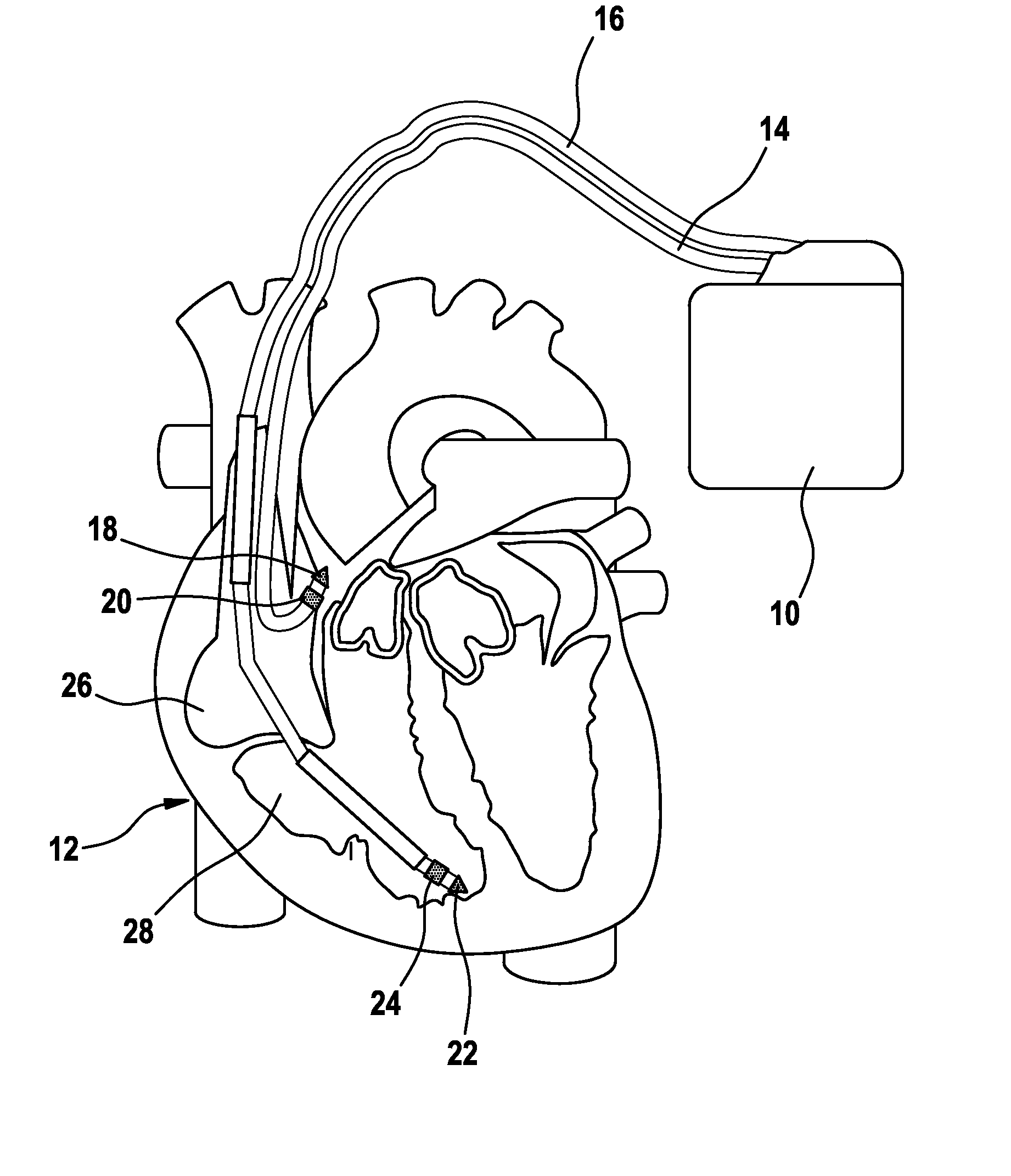 Heart stimulator