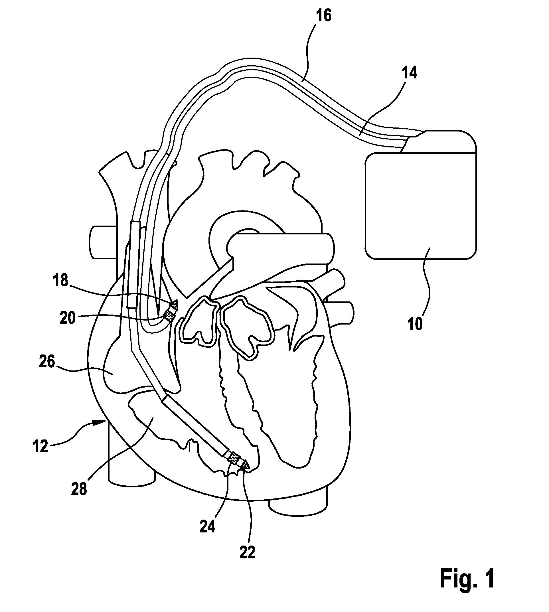 Heart stimulator