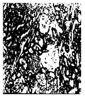 Traditional Chinese medicine composition for treating chronic nephritis proteinuria as well as preparation method and use thereof