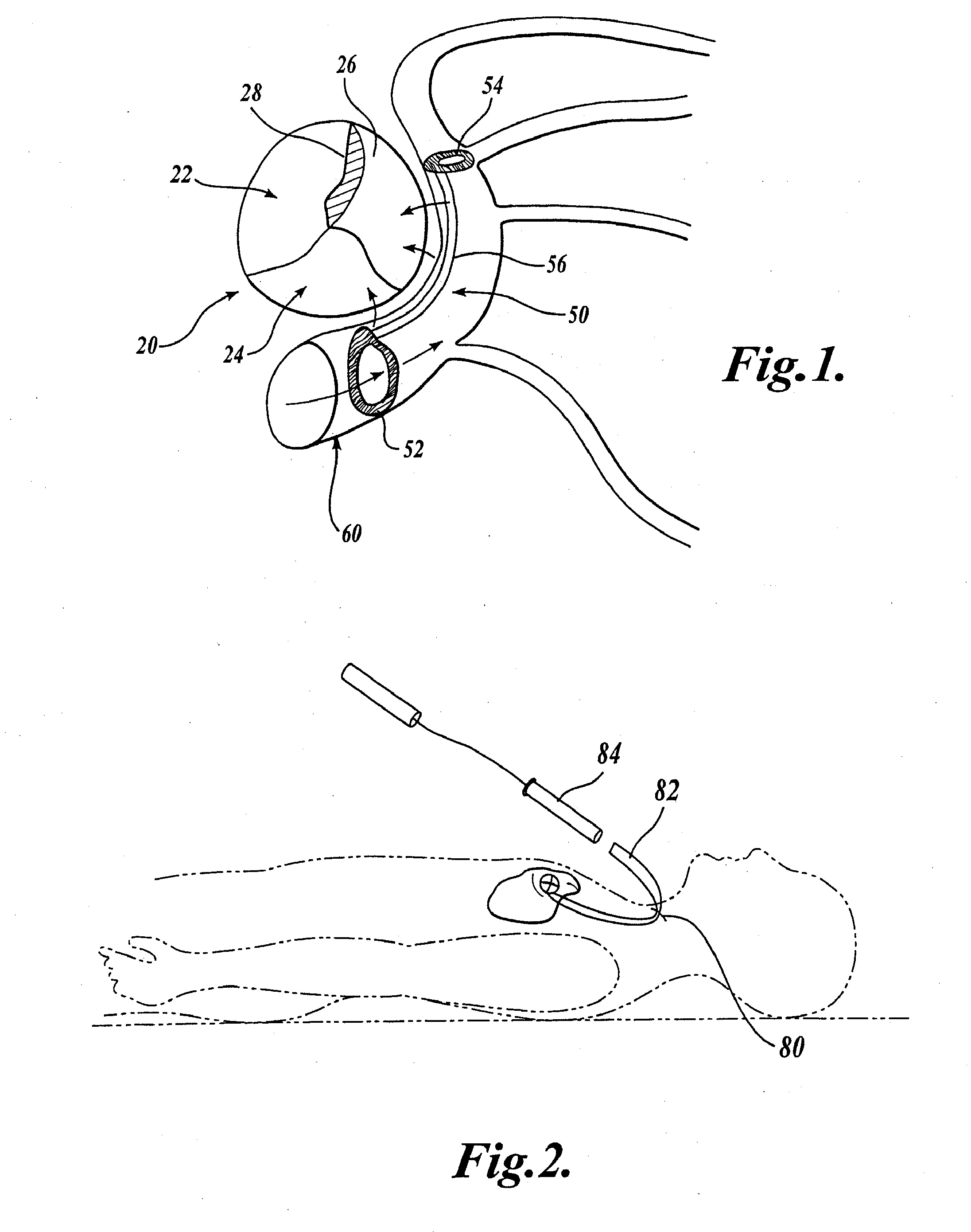 Device and method for modifying the shape of a body organ