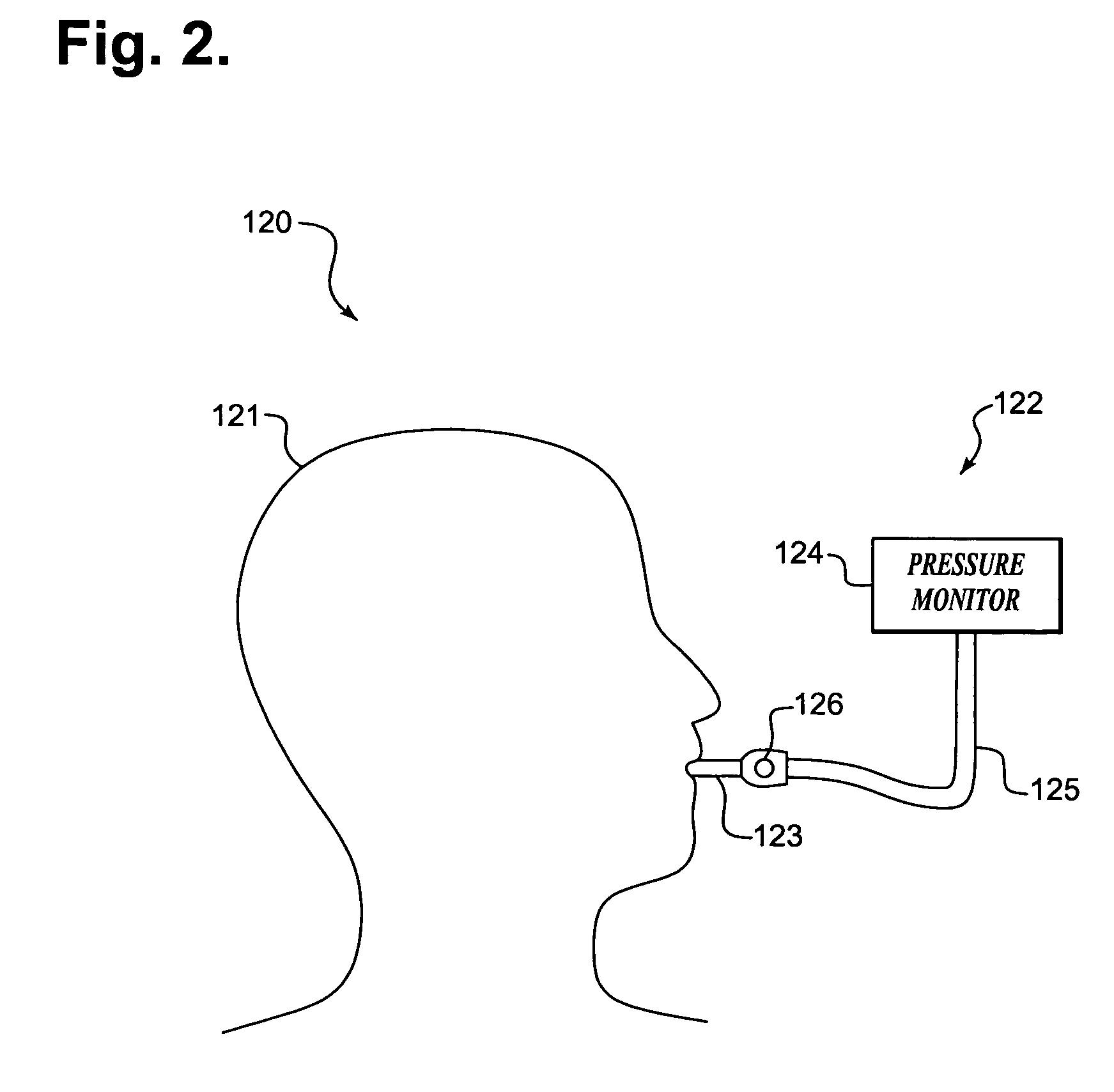 System and method for assessing cardiac performance through transcardiac impedance monitoring