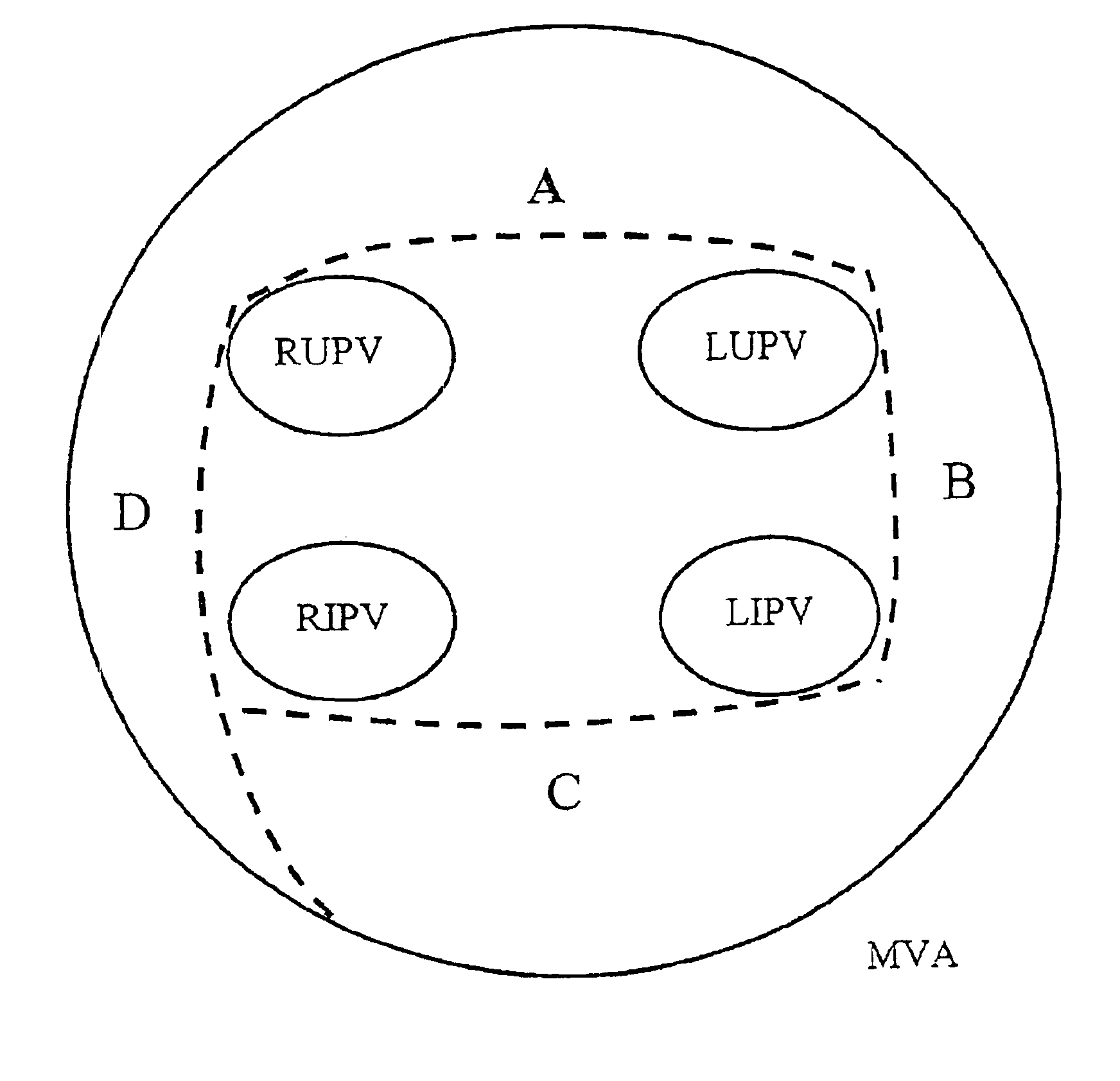 Preformed catheter set for use with a linear ablation system to produce ablation lines in the left and right atrium for treatment of atrial fibrillation