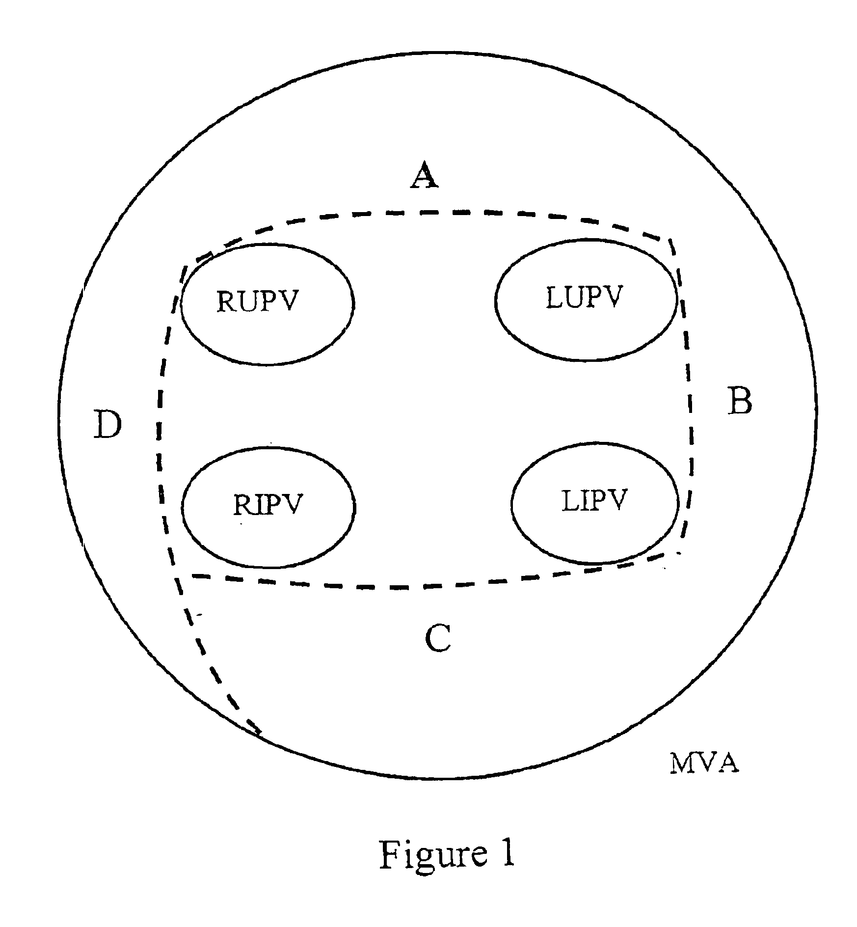 Preformed catheter set for use with a linear ablation system to produce ablation lines in the left and right atrium for treatment of atrial fibrillation