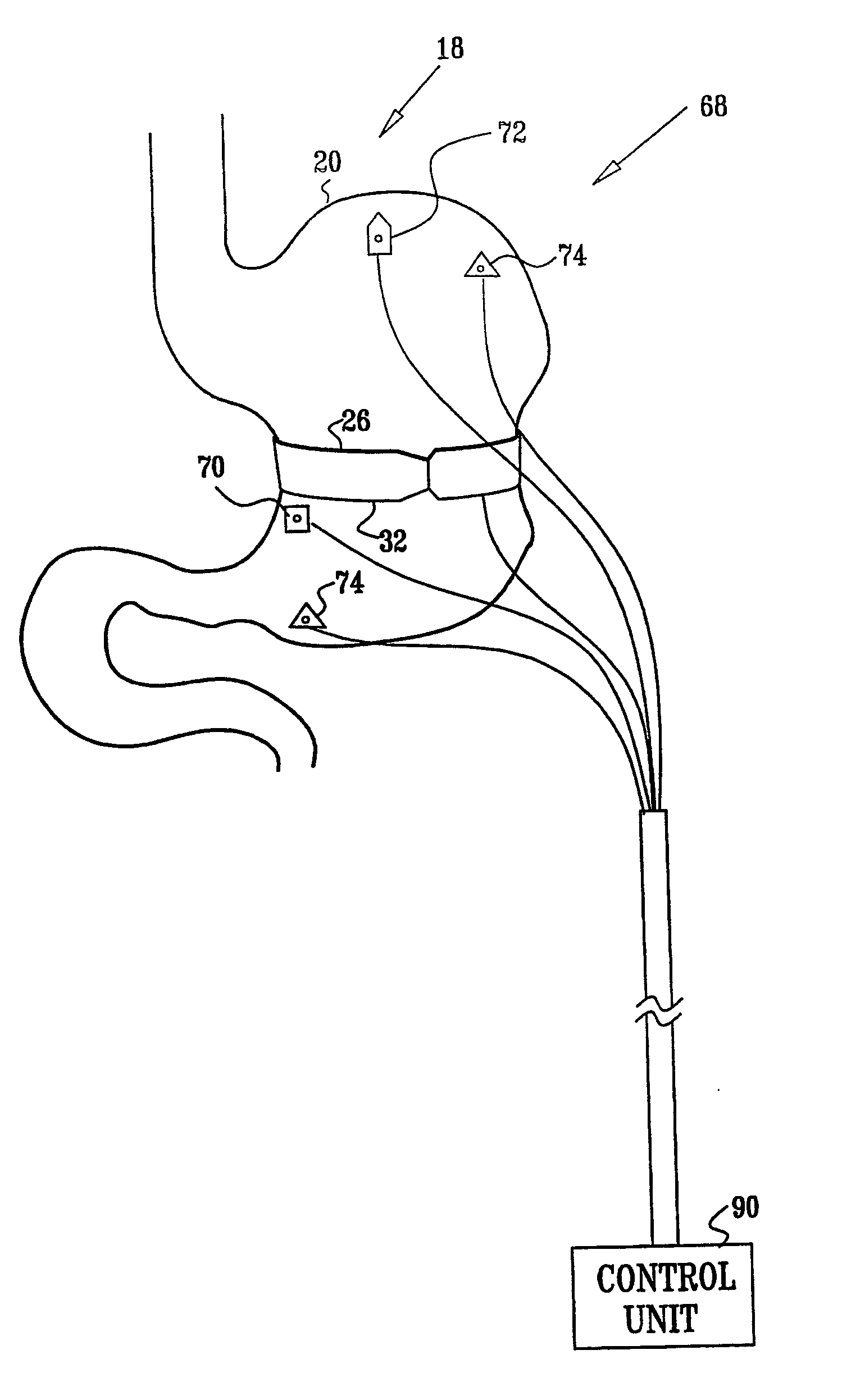 Gastrointestinal methods and apparatus for use in treating disorders