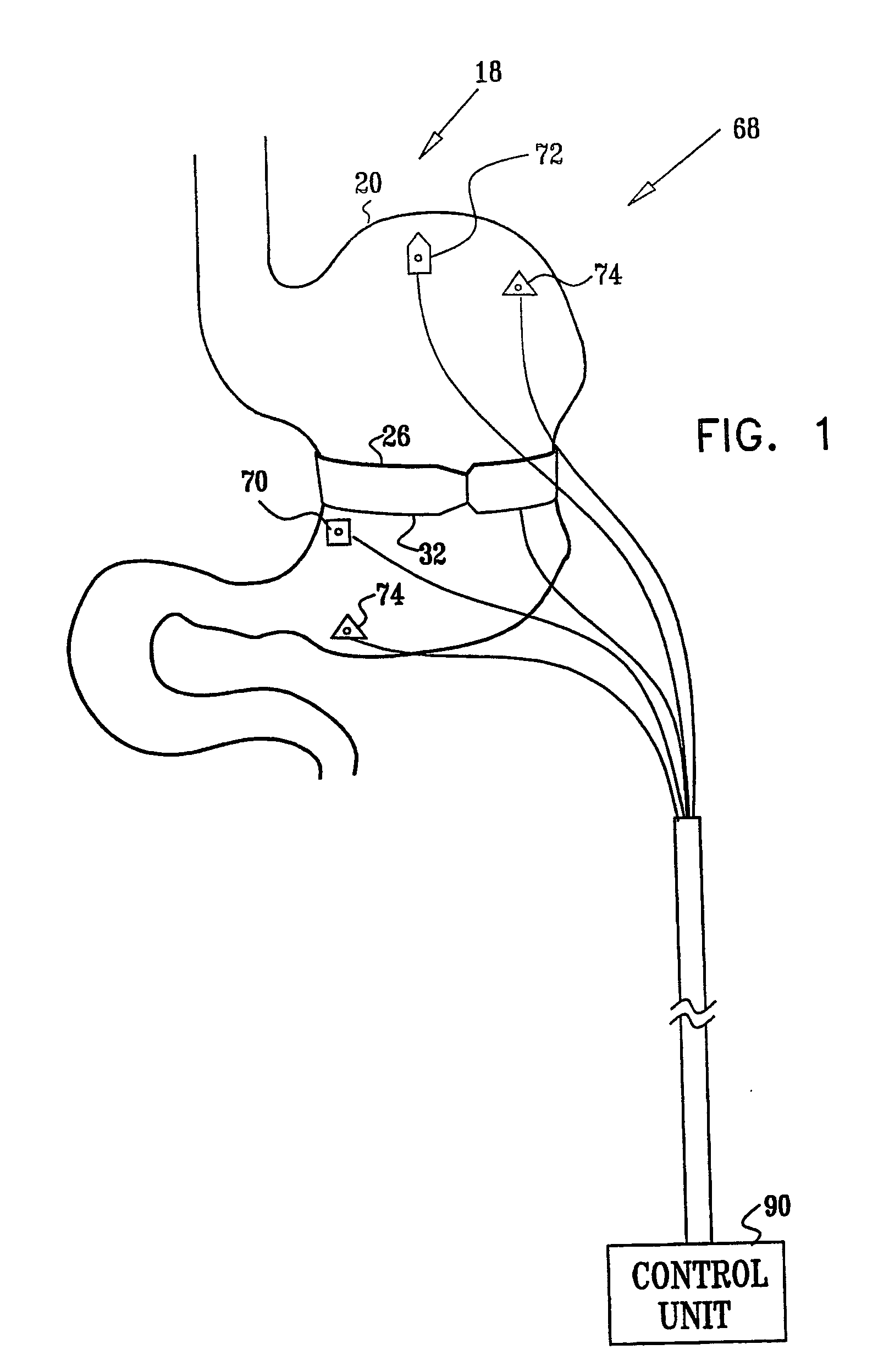 Gastrointestinal methods and apparatus for use in treating disorders