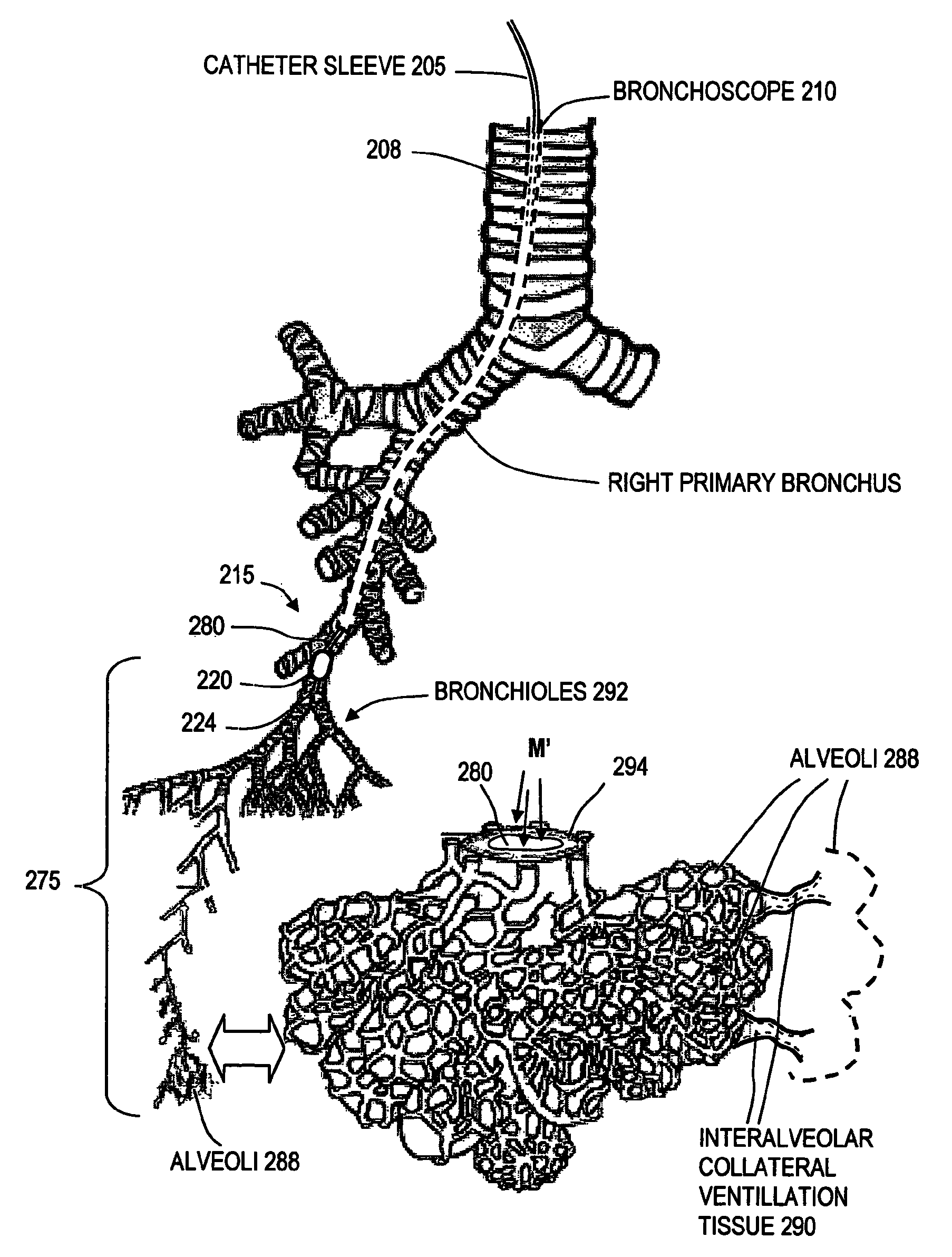 Medical instruments and techniques for treating pulmonary disorders