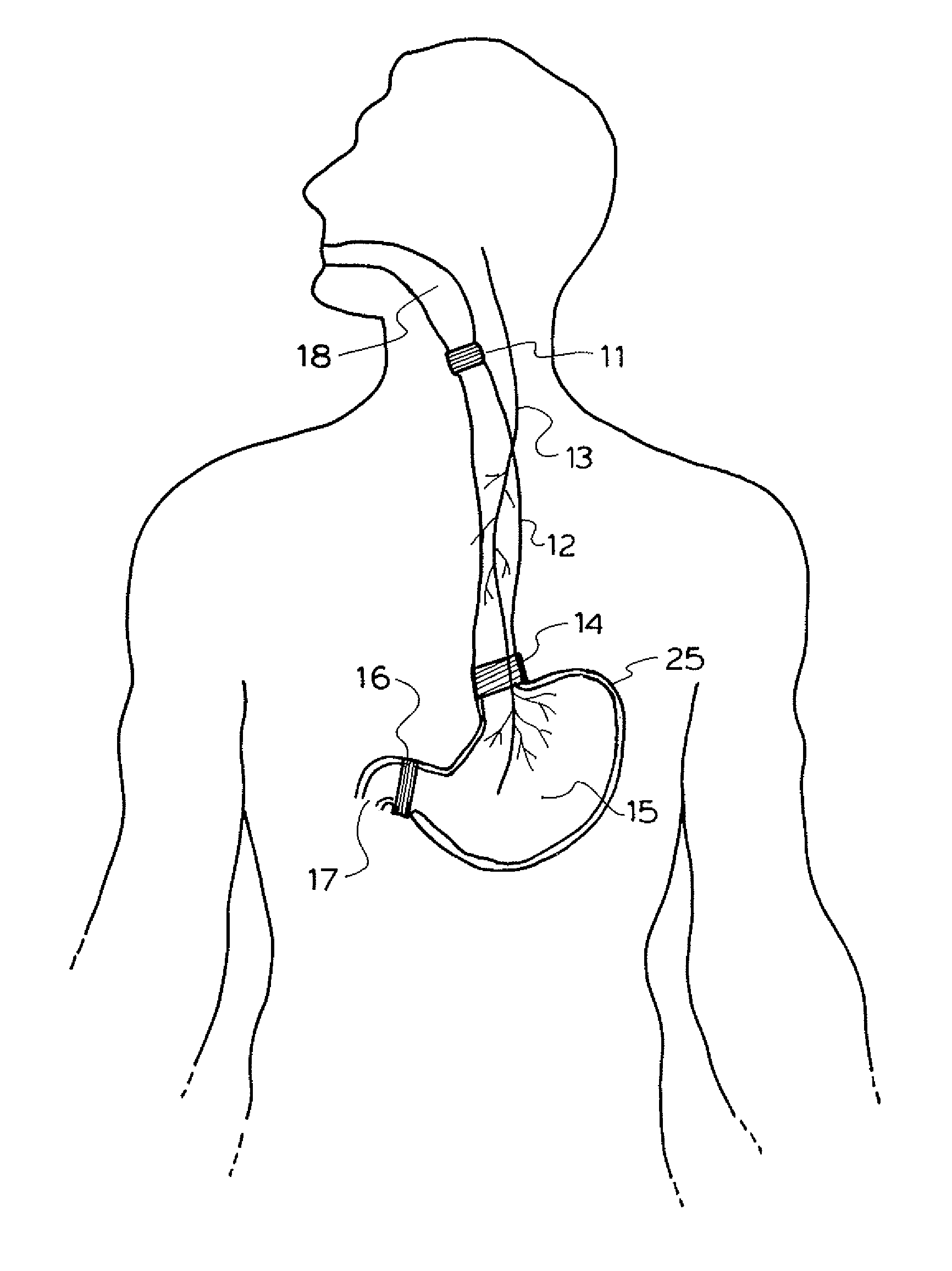 Method and apparatus for treatment of the gastrointestinal tract