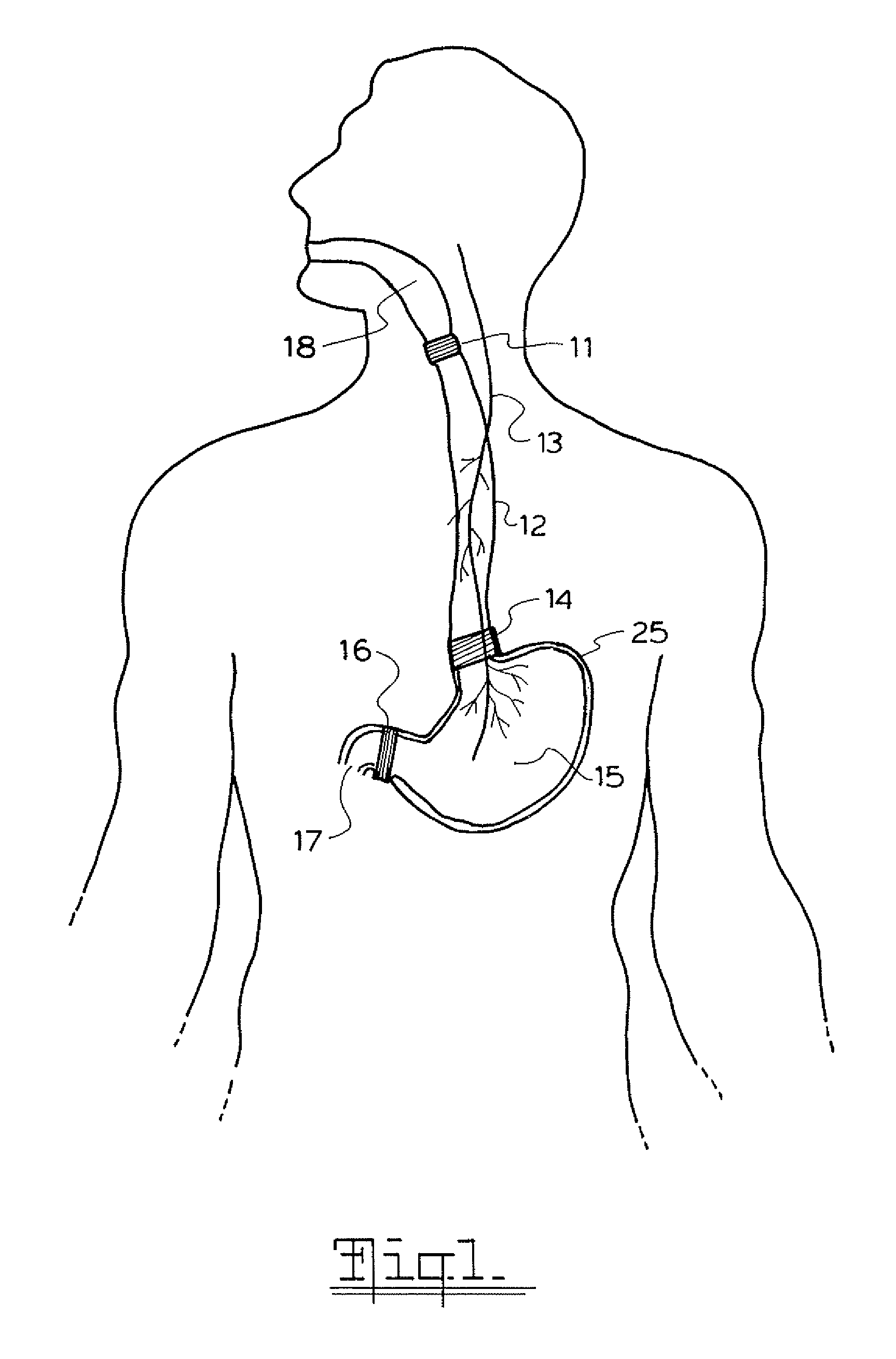 Method and apparatus for treatment of the gastrointestinal tract