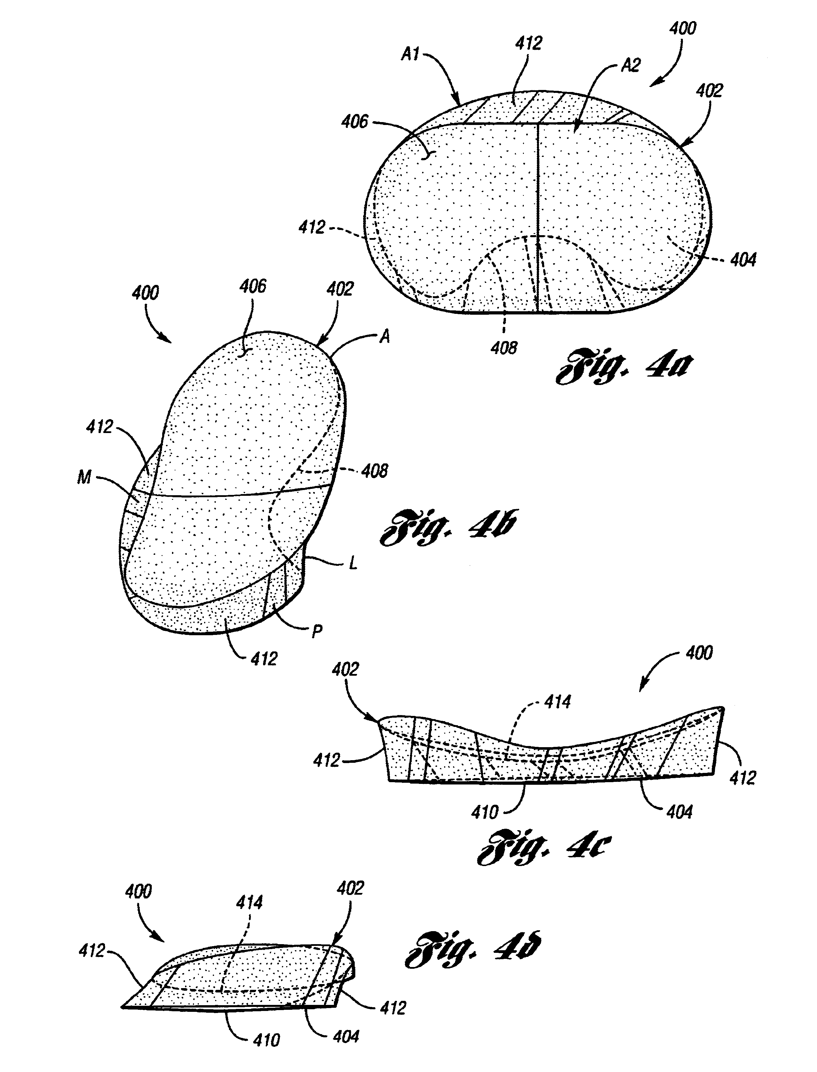 Surgically implantable knee prosthesis having different tibial and femoral surface profiles