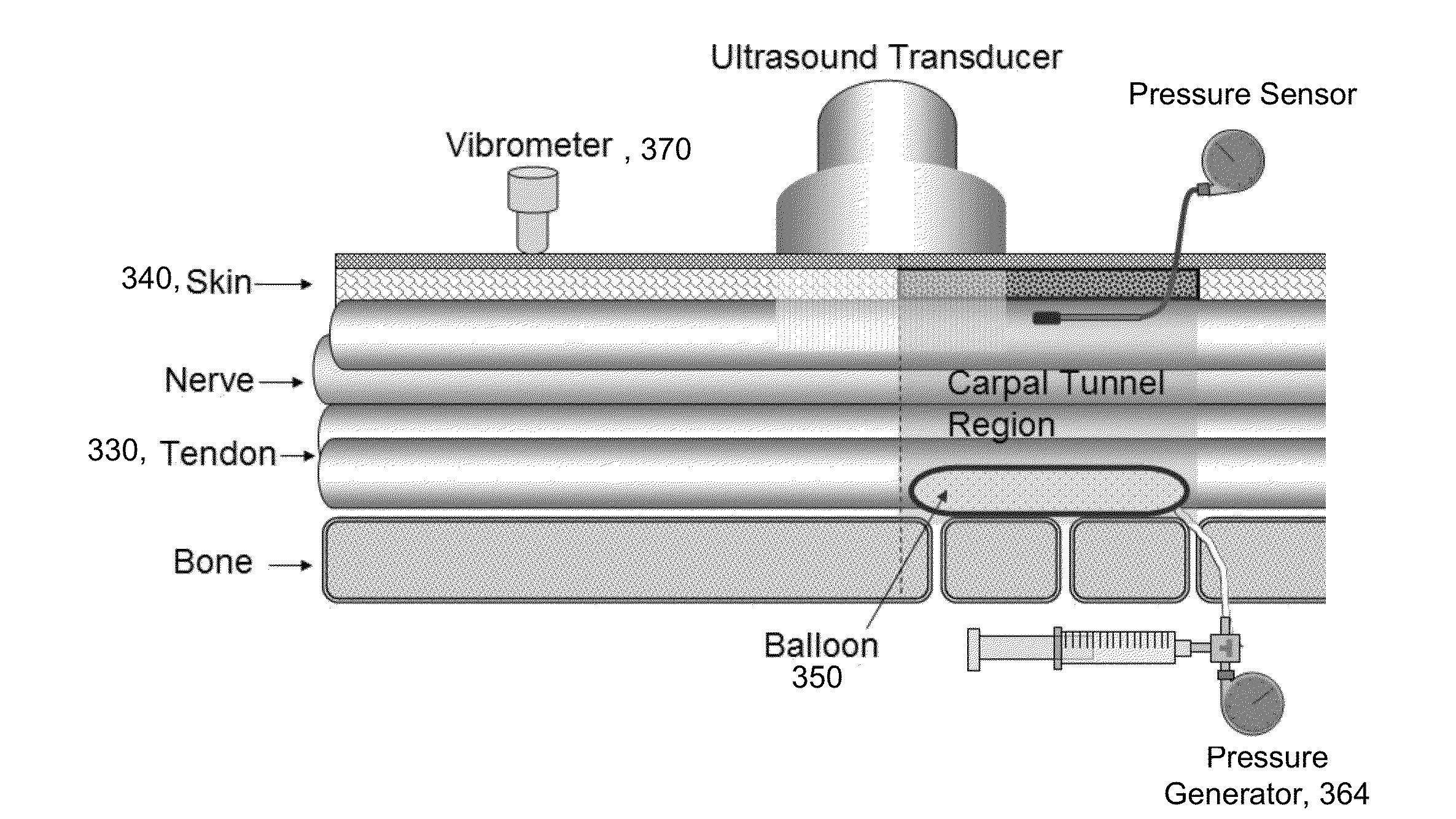 System and method for non-invasive measurement of carpal tunnel pressure