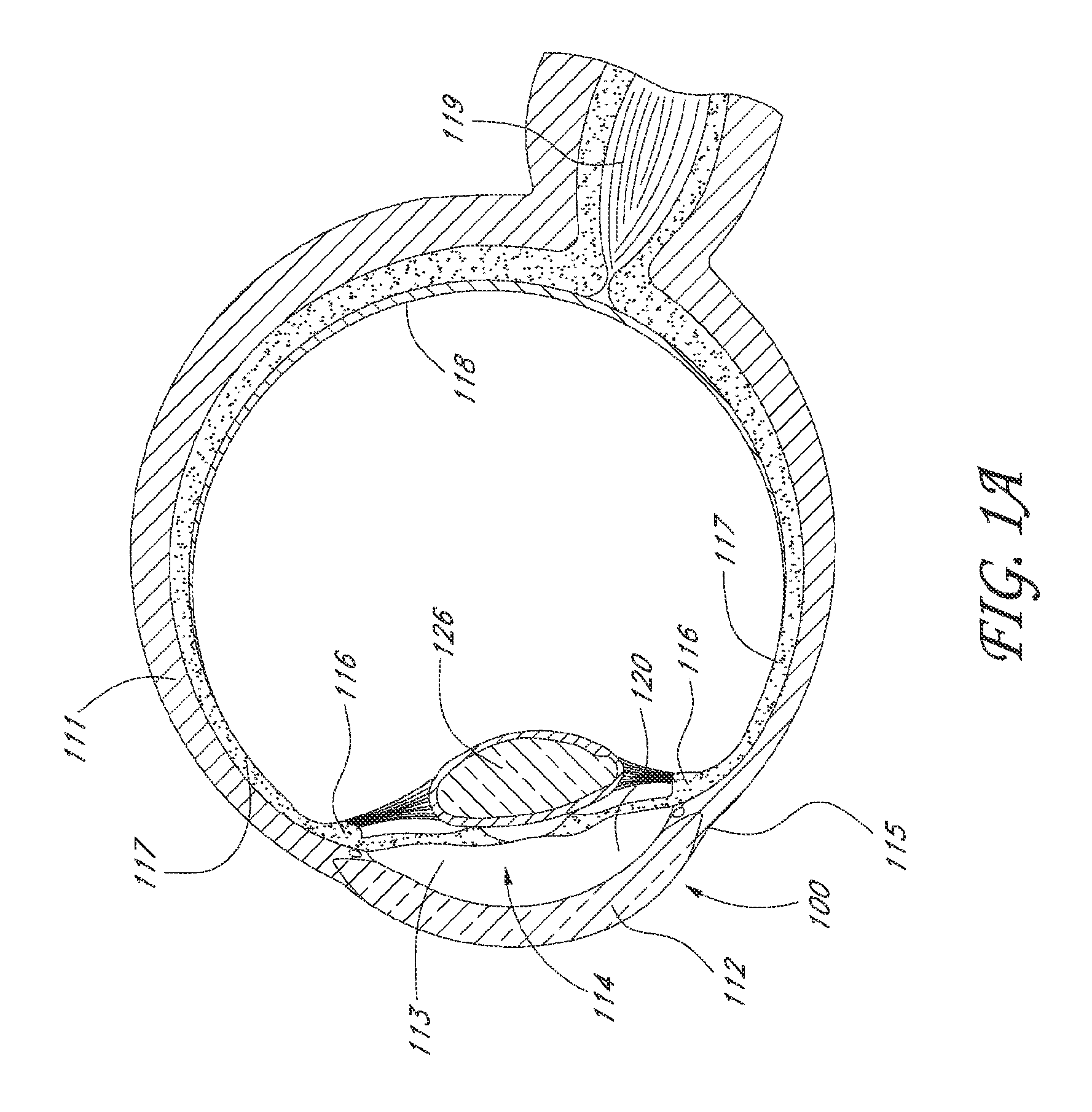 System for delivering multiple ocular implants