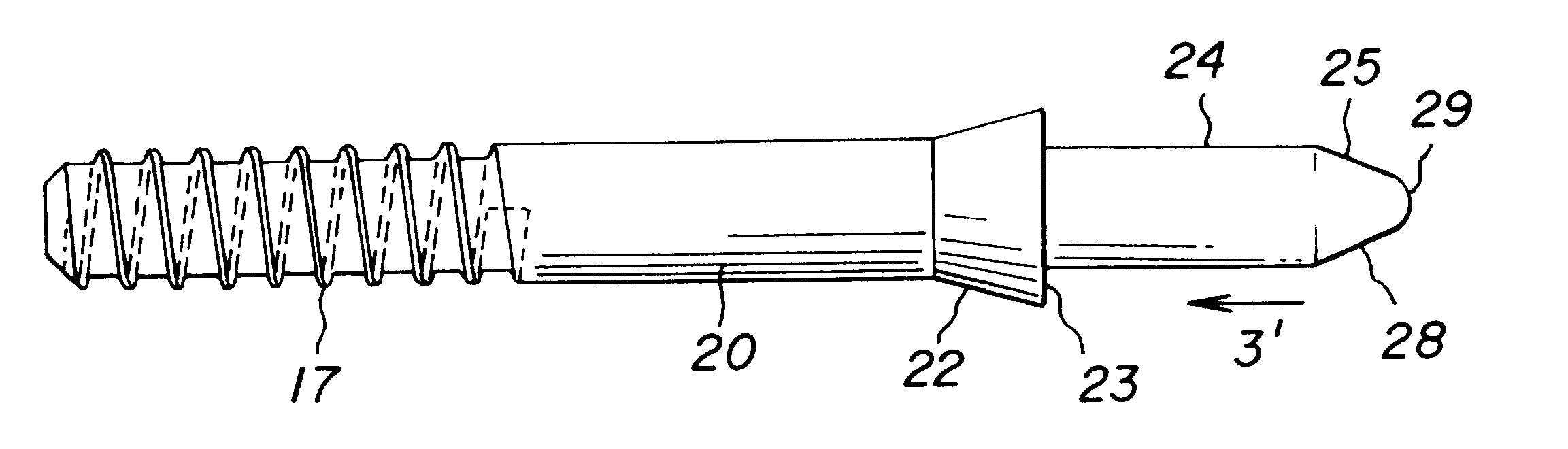 Allograft bone fixation screw