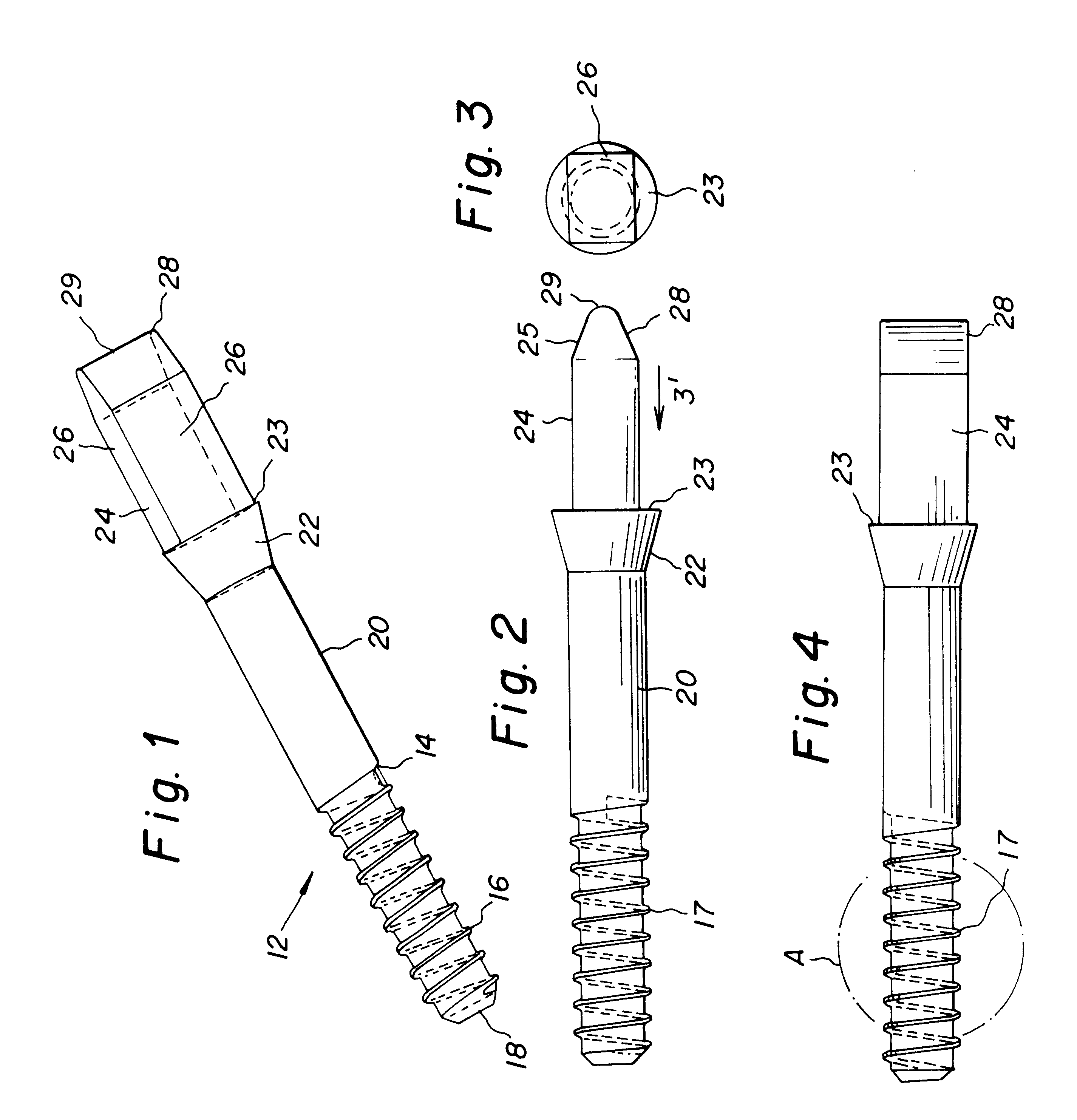 Allograft bone fixation screw