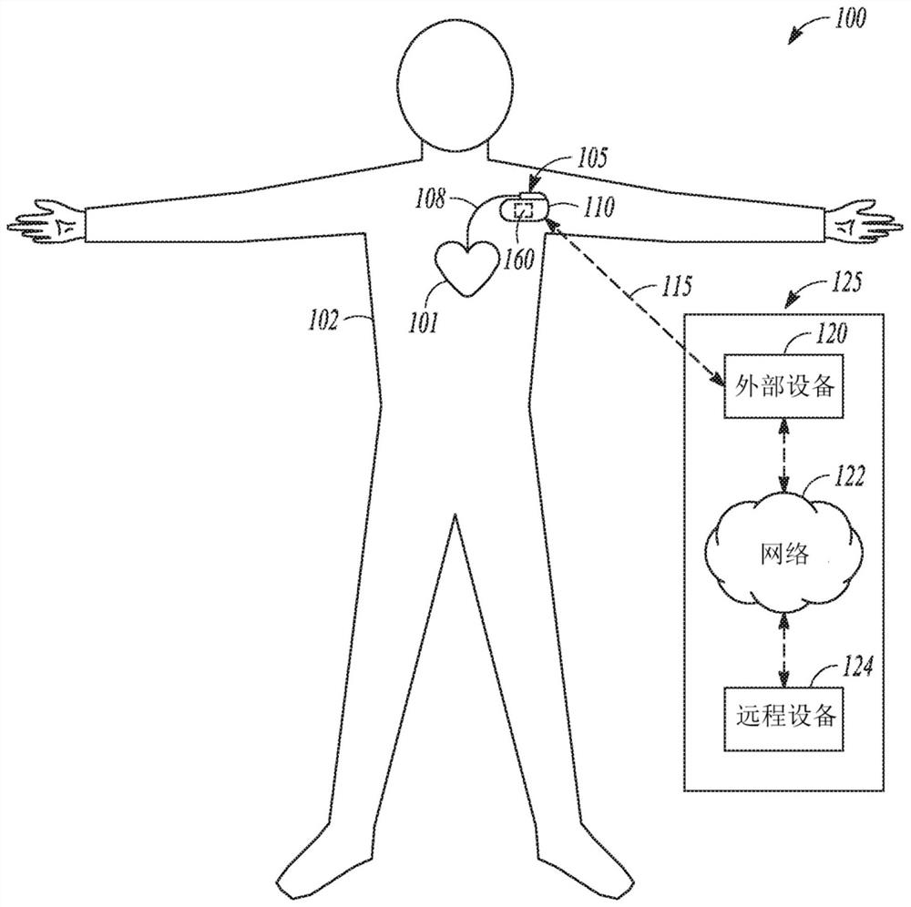 Systems and methods for detecting worsening heart failure