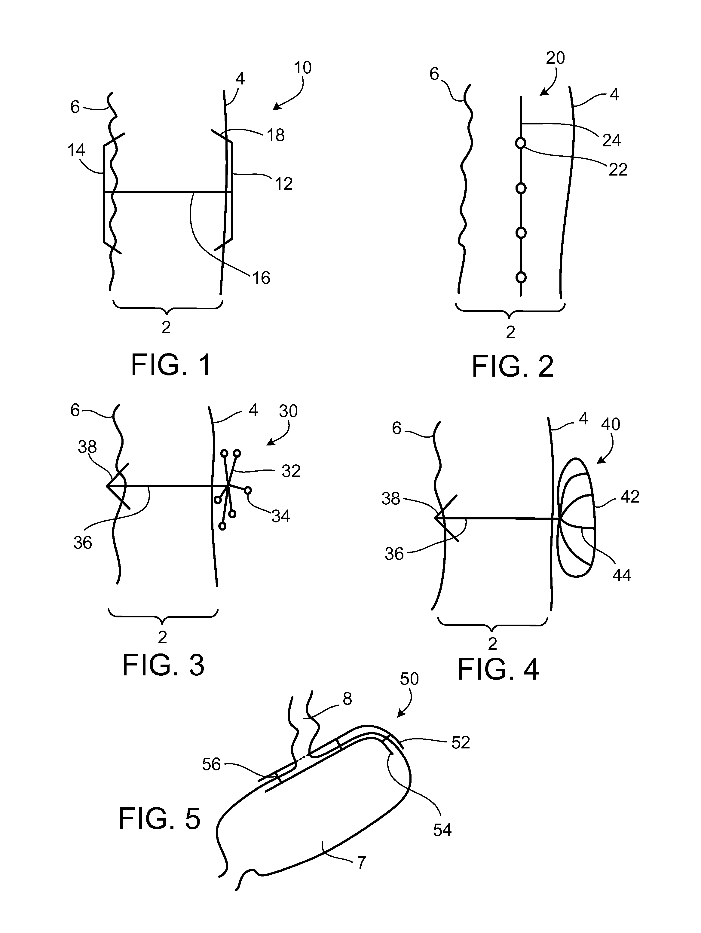 Disrupting electrical activity in the stomach