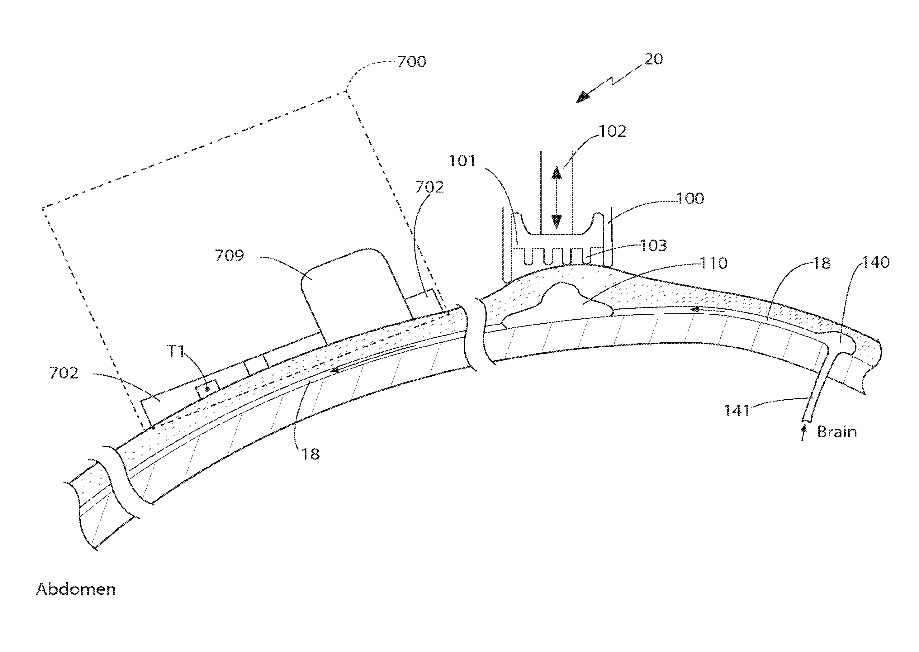 CSF shunt flow enhancer, method for generating CSF flow in shunts and assessment of partial and complete occlusion of CSF shunt systems