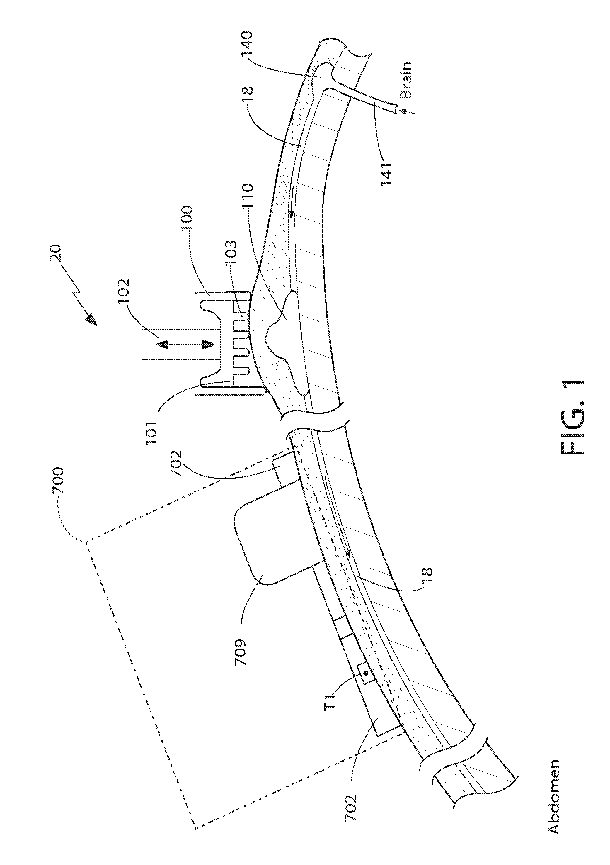 CSF shunt flow enhancer, method for generating CSF flow in shunts and assessment of partial and complete occlusion of CSF shunt systems