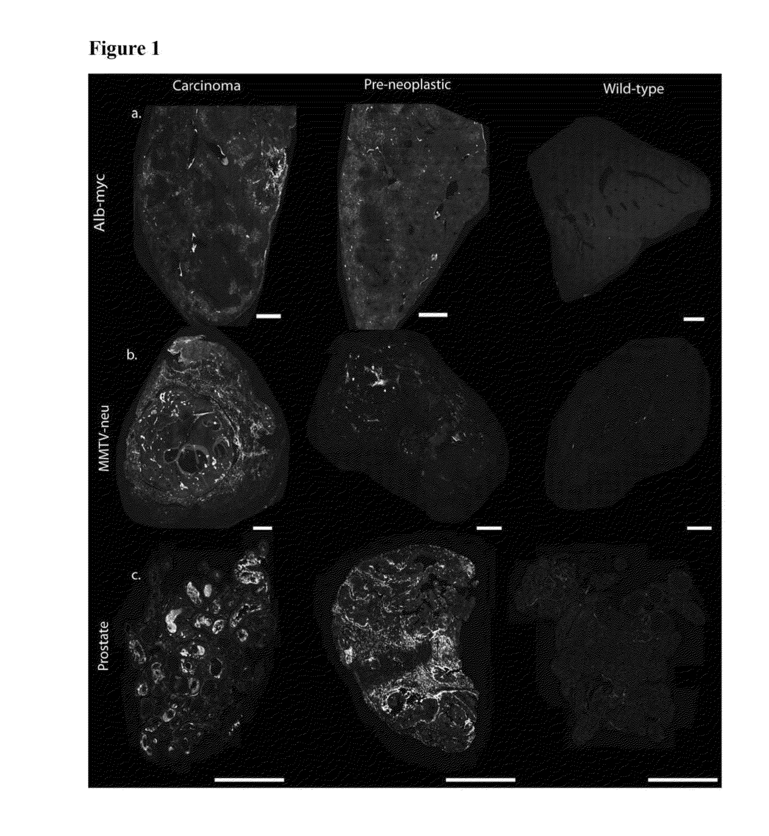 Methods of detecting and treating cancers using autoantibodies