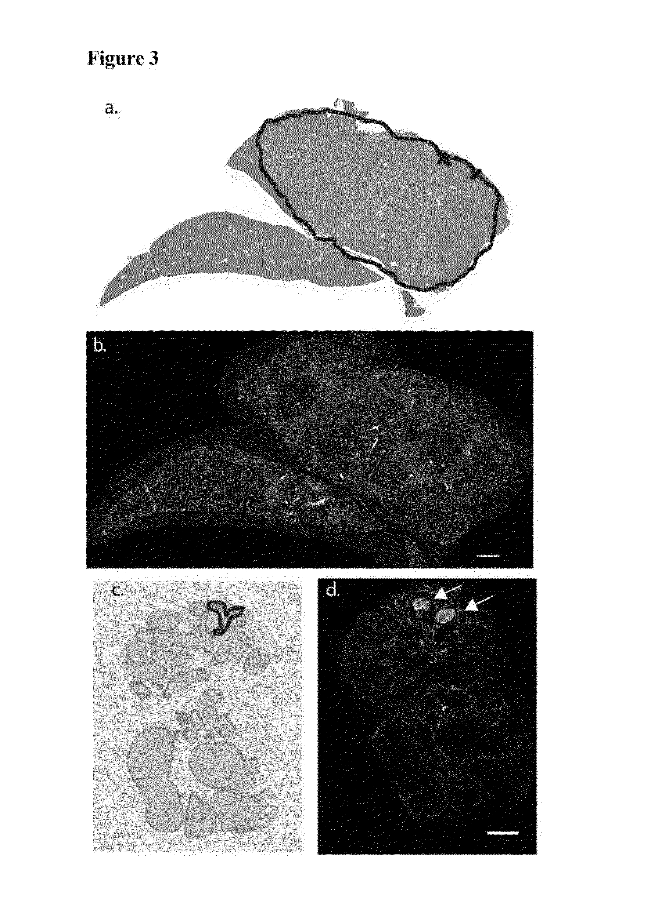 Methods of detecting and treating cancers using autoantibodies