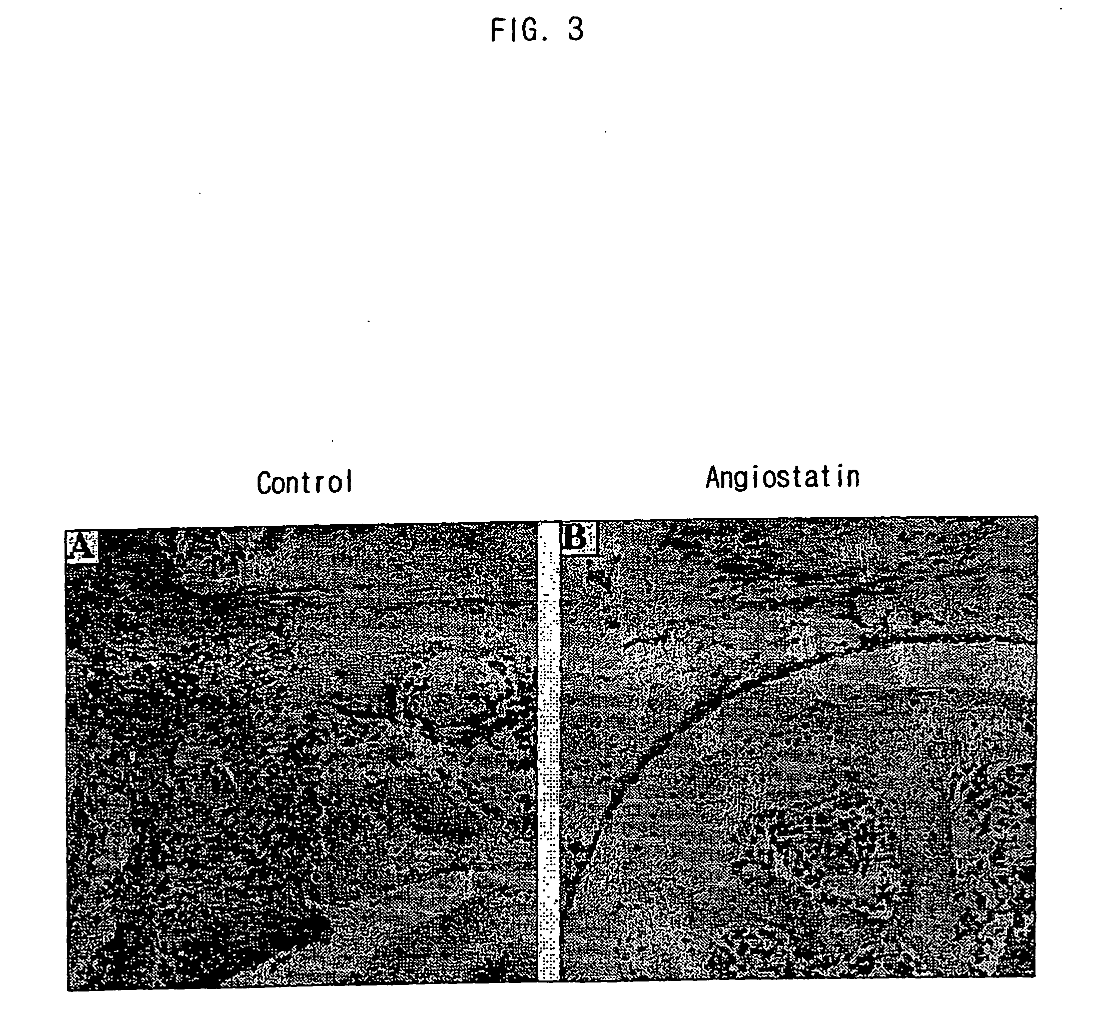 Compositions for gene therapy of rheumatoid arthritis including a gene encoding an anti-angiogenic protein or parts thereof