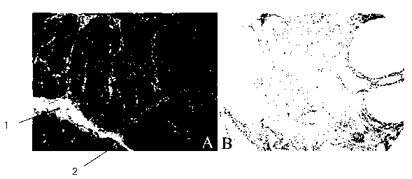 A method for simultaneous detection of cancer-associated fibroblasts and expressed proteins thereof