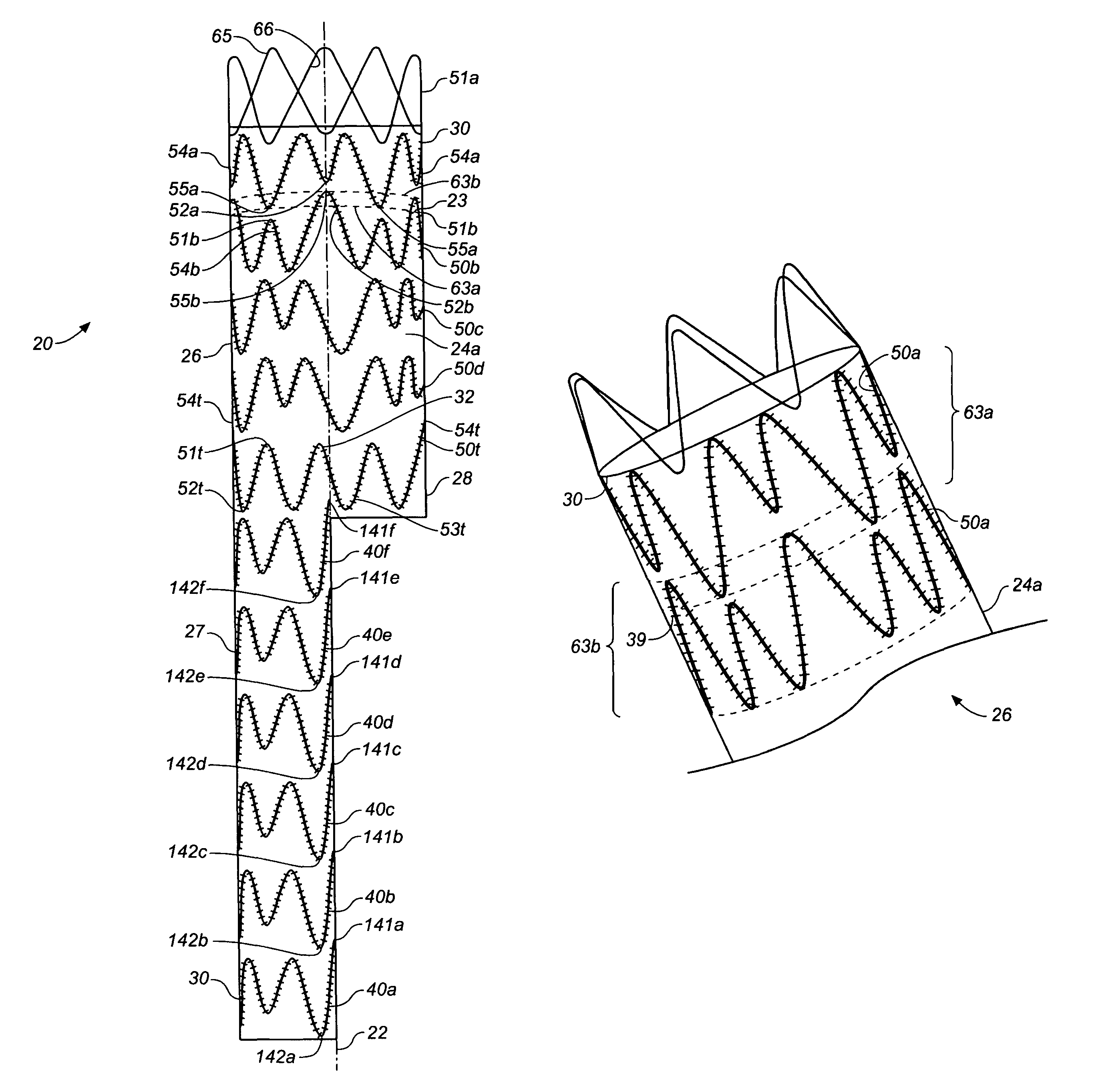 Endoluminal prosthesis