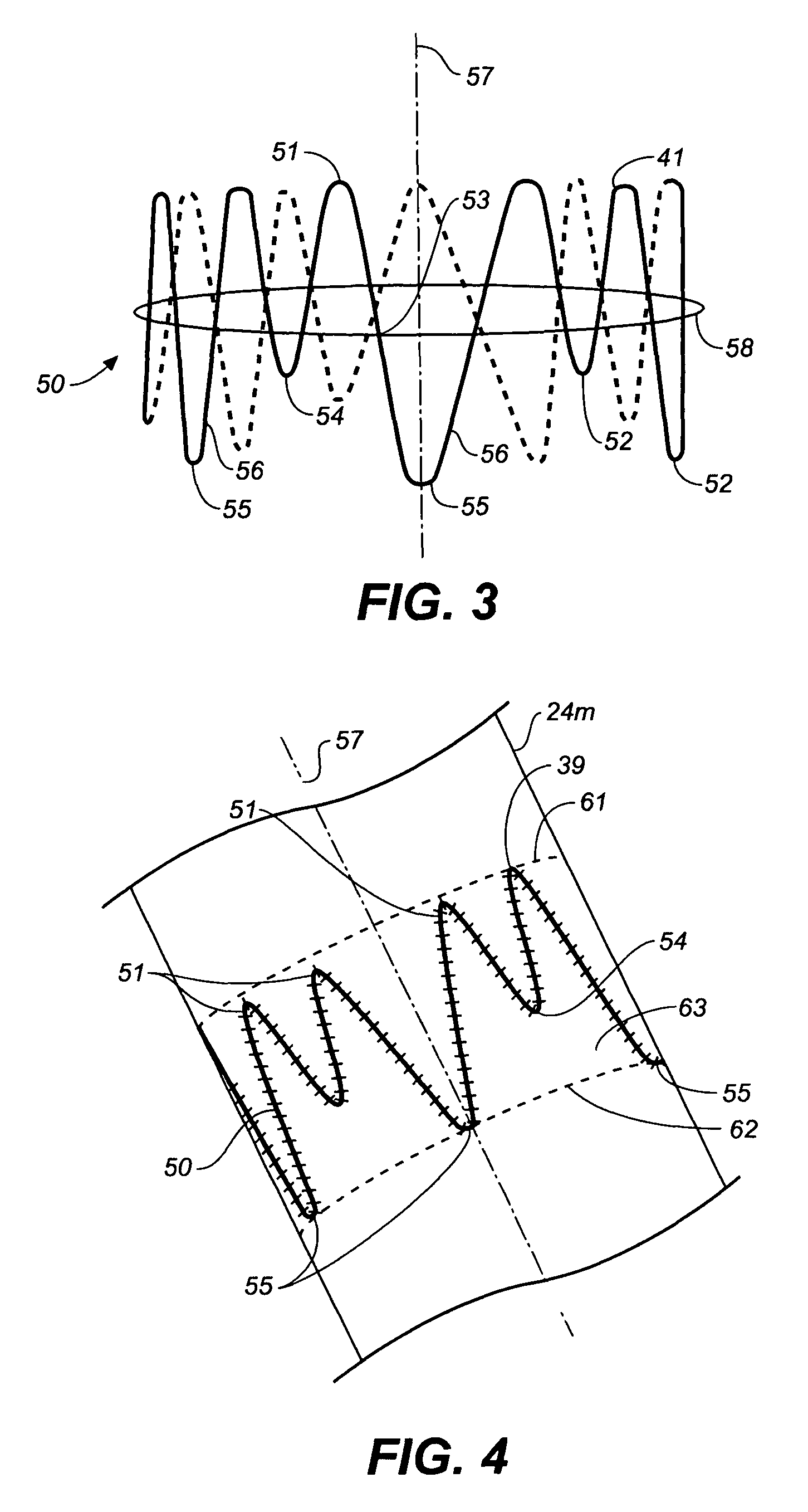 Endoluminal prosthesis