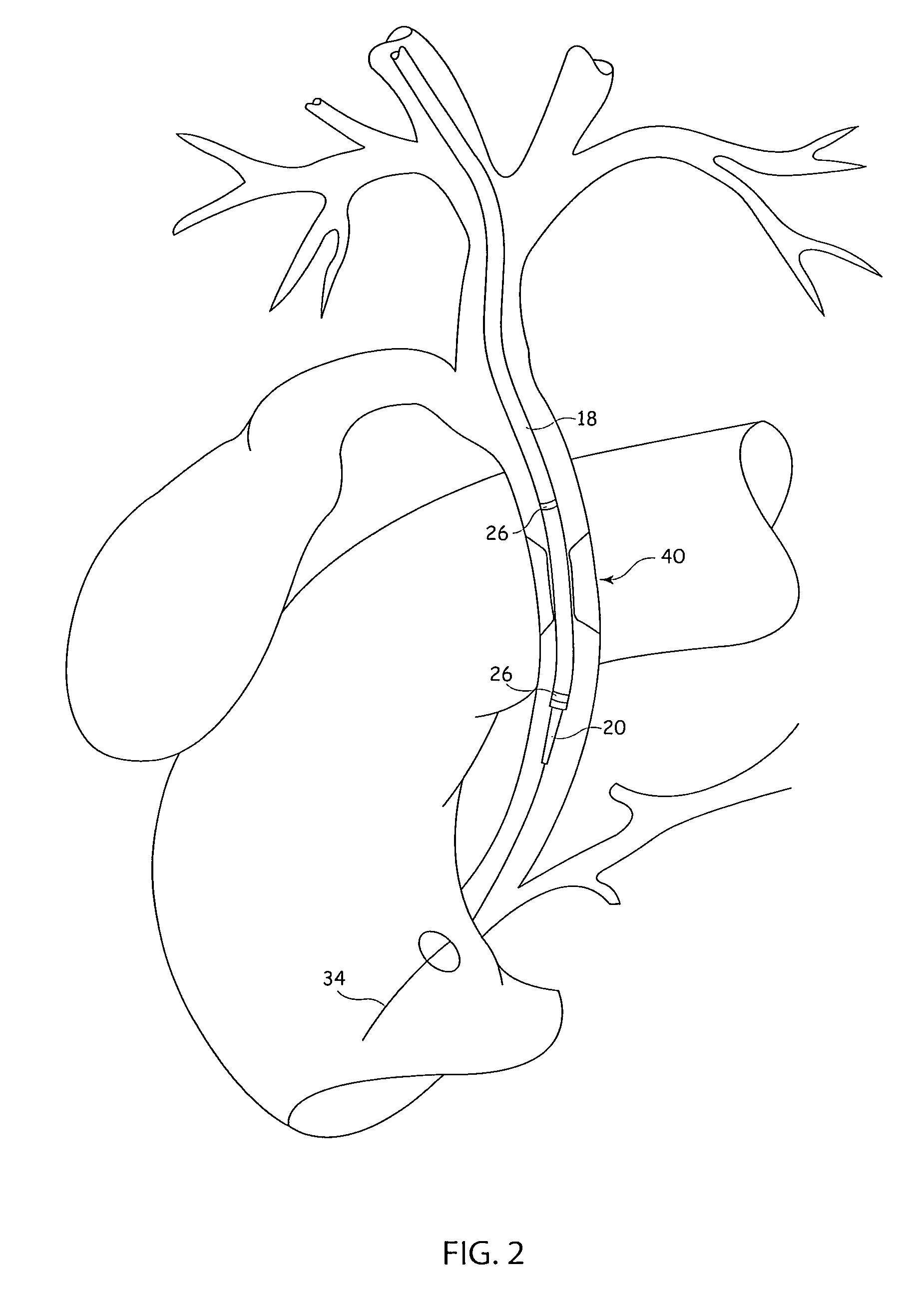 Deployment handle for an implant deployment device