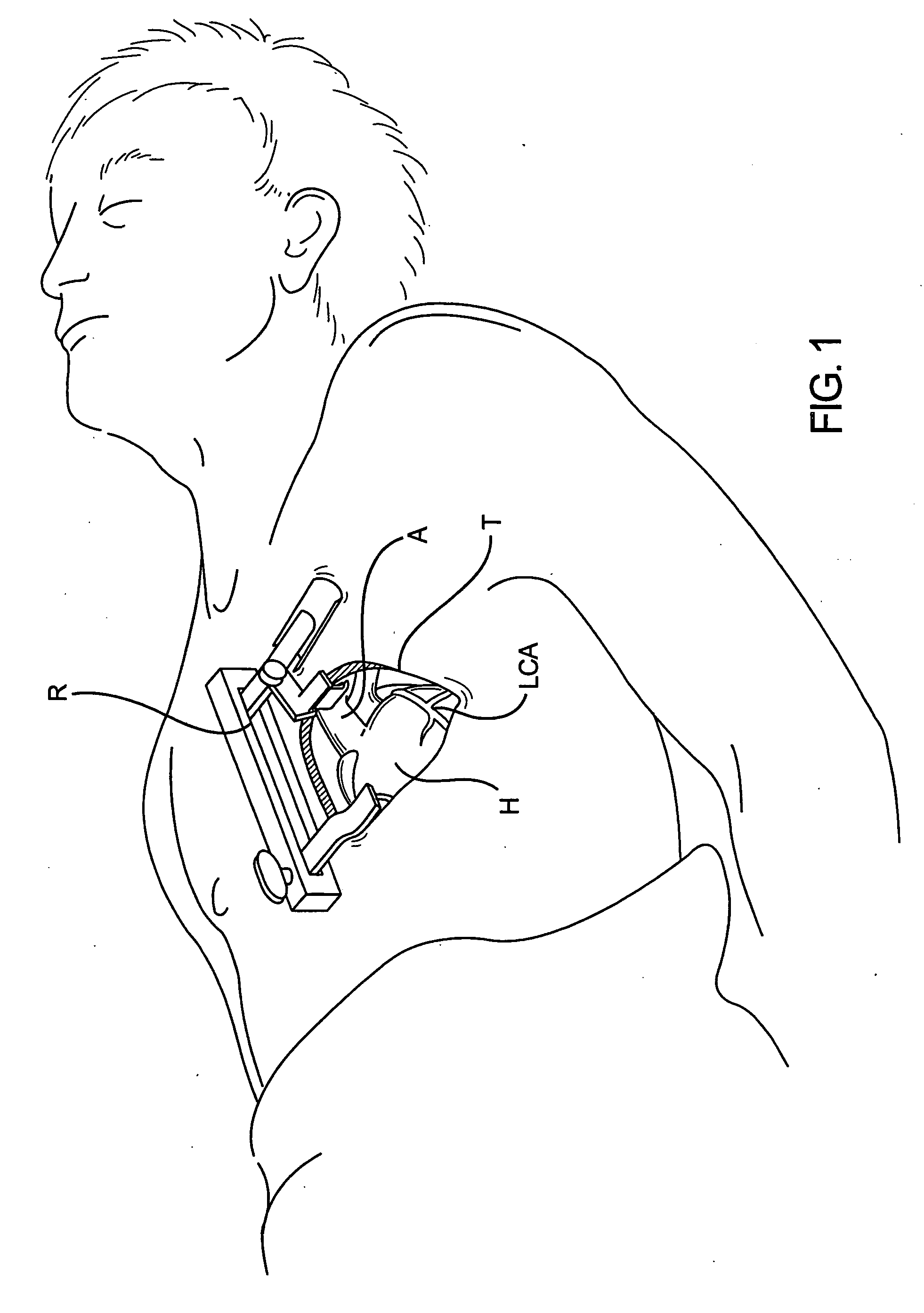 Devices and methods for use in performing transmyocardial coronary bypass