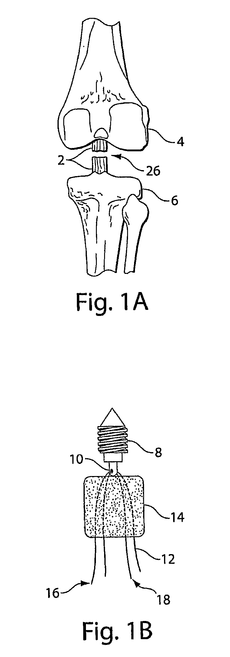 Methods and procedures for ligament repair