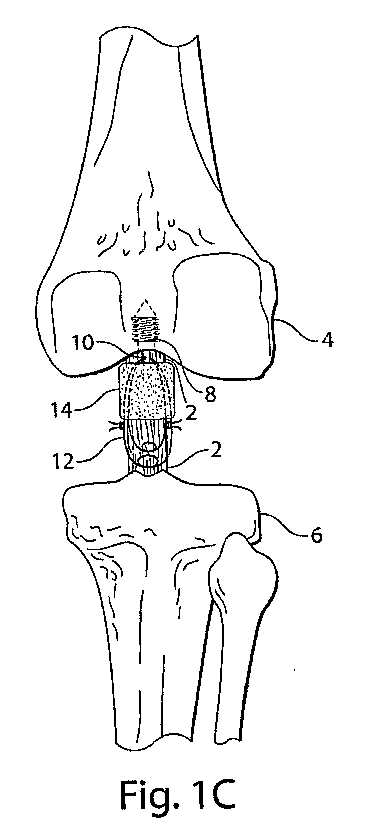 Methods and procedures for ligament repair